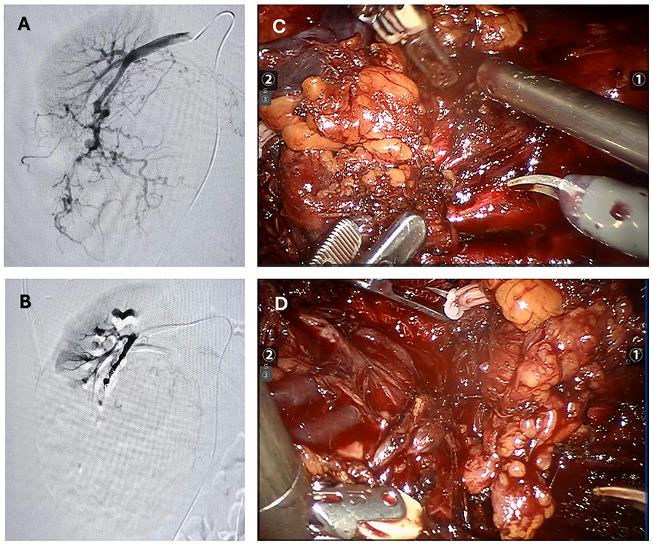 Panel A shows a grayscale angiographic image with detailed vascular structures. Panel B depicts another angiographic image highlighting distinct blood vessels. Panel C displays a surgical close-up of tissue with instruments in use, revealing detailed anatomy and texture. Panel D shows another surgical view with additional tissue and instruments, providing perspective on the procedure's complexity.