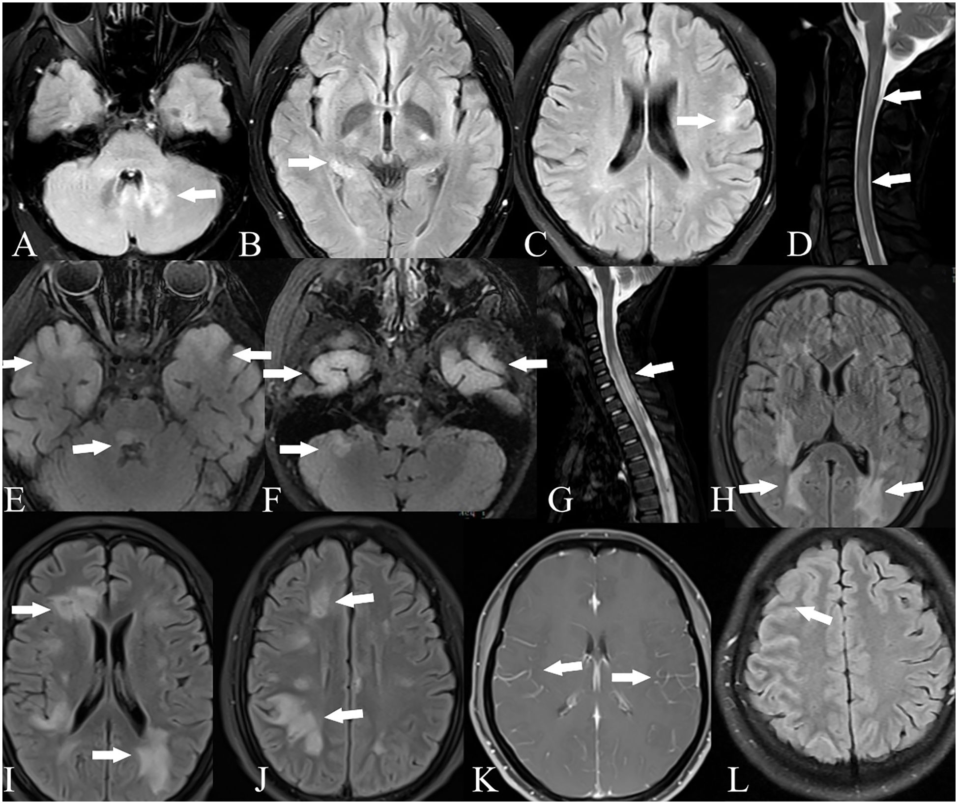 Medical imaging showing multiple axial and sagittal MRI scans of the brain and spinal cord, labeled A to L. Arrows indicate areas of interest, highlighting abnormal regions or lesions. The images illustrate different cross-sections and orientations, focusing on various parts of the brain and spine for diagnostic purposes.