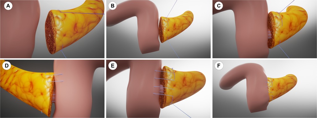 A series of six 3D model images demonstrating modified Blumgart pancreaticojejunostomy technique. Panel A shows pancreatic stump preparation. Panel B shows anterior anchor line establishment. Panel C displays pancreatic duct stent placement. Panel D illustrates horizontal mattress sutures placement. Panel E shows completed suturing with knots tied. Panel F demonstrates omental padding fixation behind the anastomosis.