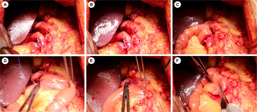 Six intraoperative photographs showing sequential steps of modified Blumgart pancreaticojejunostomy. Panel A shows pancreatic stump preparation. Panel B displays anchor line establishment. Panel C shows duct stent placement. Panel D illustrates mattress sutures placement. Panel E shows completed suturing. Panel F demonstrates omental padding fixation. Images correspond to the 3D model sequence in Figure 3.