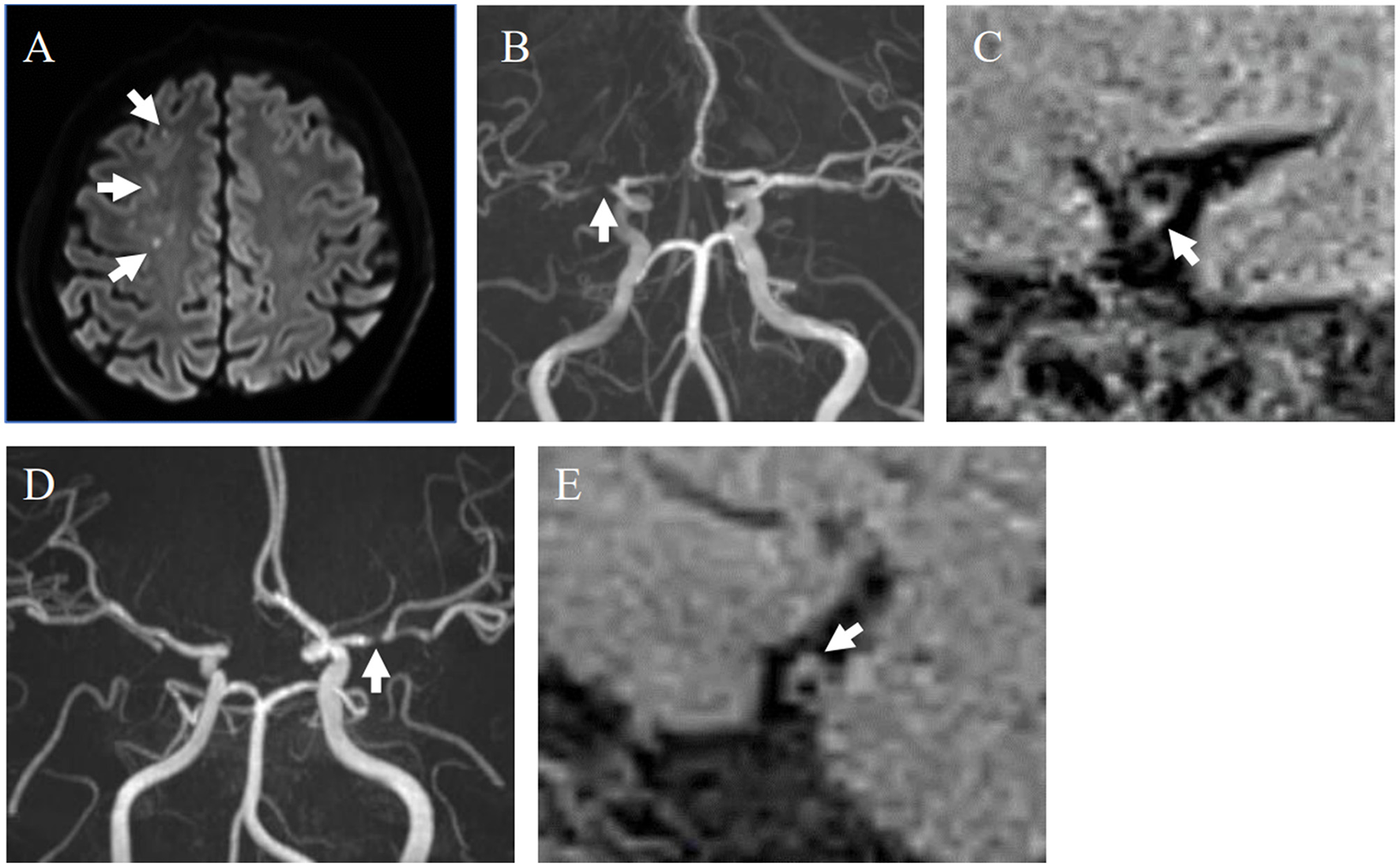 Panel A shows an MRI of a brain with three arrows pointing to areas of interest. Panel B and D display MRA images highlighting arterial structures with arrows. Panel C and E, close-up MRI sections, have arrows indicating specific brain areas.