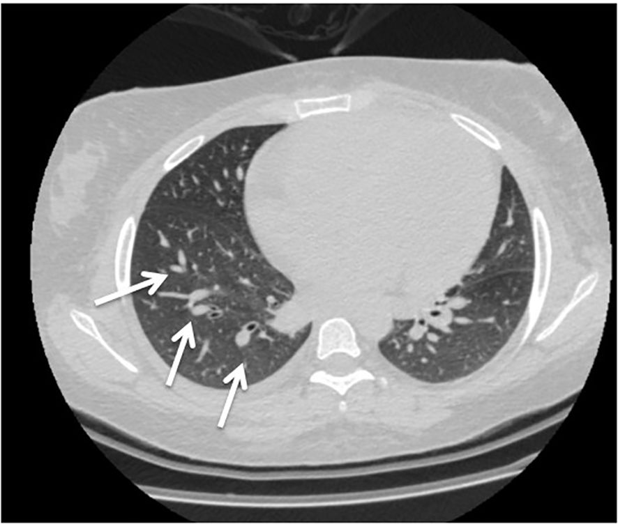 CT scan of the chest displaying both lungs. The left lung shows circular, dark areas surrounded by white arrows, indicating abnormalities. The right lung appears relatively clear.