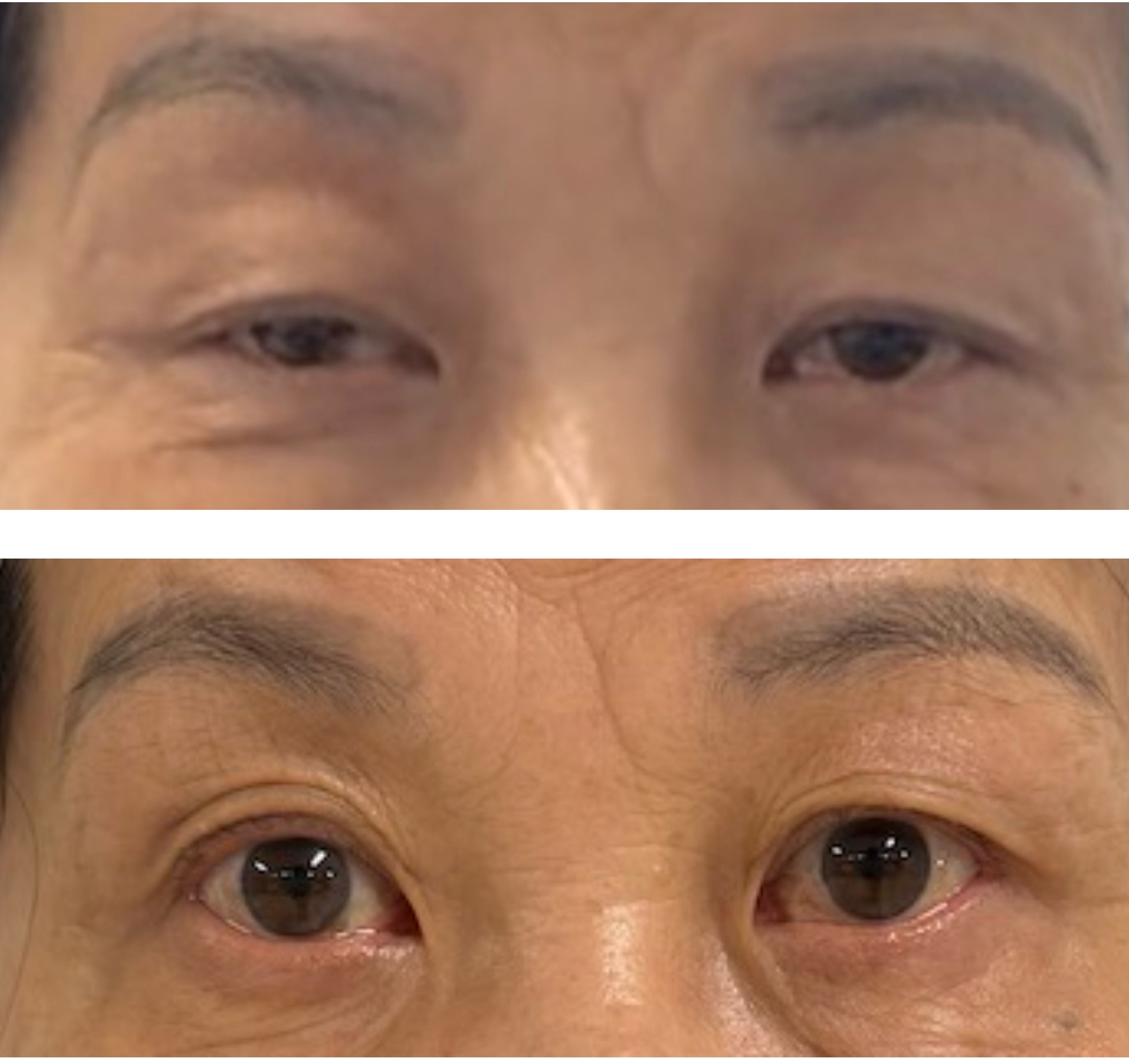 Close-up images of a person's eyes before and after a procedure. The top image shows droopy eyelids, while the bottom image shows the eyes open wider, suggesting a successful intervention.