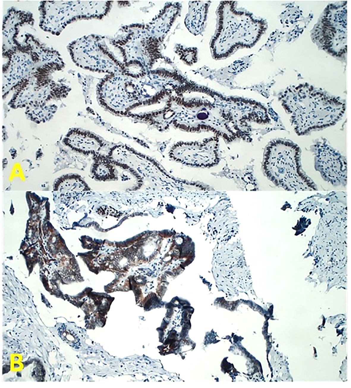Microscopic images labeled A and B showing tissue samples with dark-stained cellular structures and varying levels of detail. In that different primary monoclonal antibody have been used in Image A as compared with Image B. So the pattern of immune staming is different in the two situations.