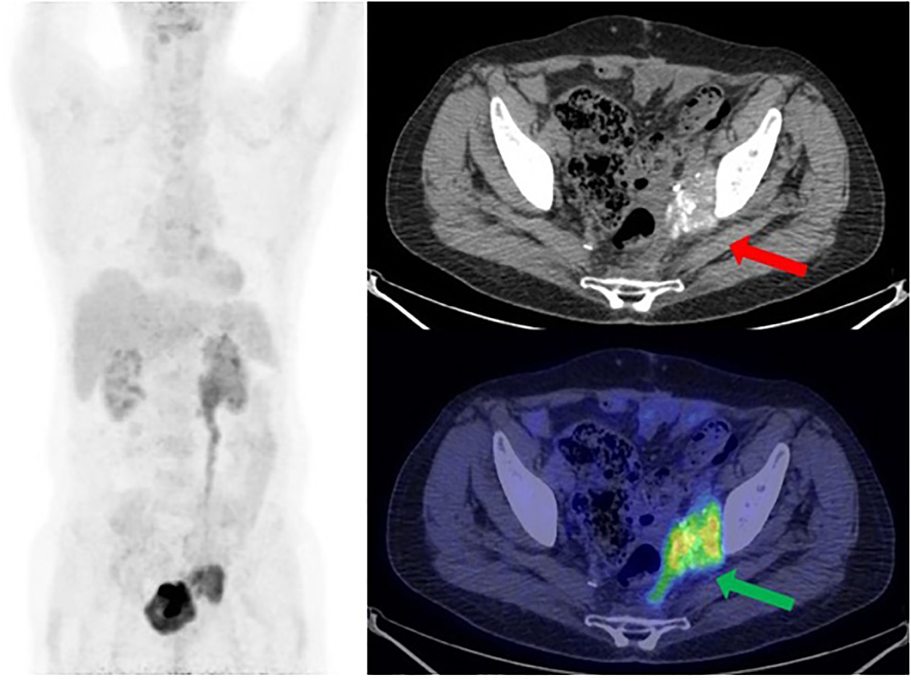 Composite medical imaging. Left: A grayscale PET scan showing varying densities in the body. Right: Two CT cross-sections. Top CT shows a red arrow highlighting an abnormality. Bottom CT with PET overlay shows a green arrow pointing to a brightly colored area, indicating increased metabolic activity.