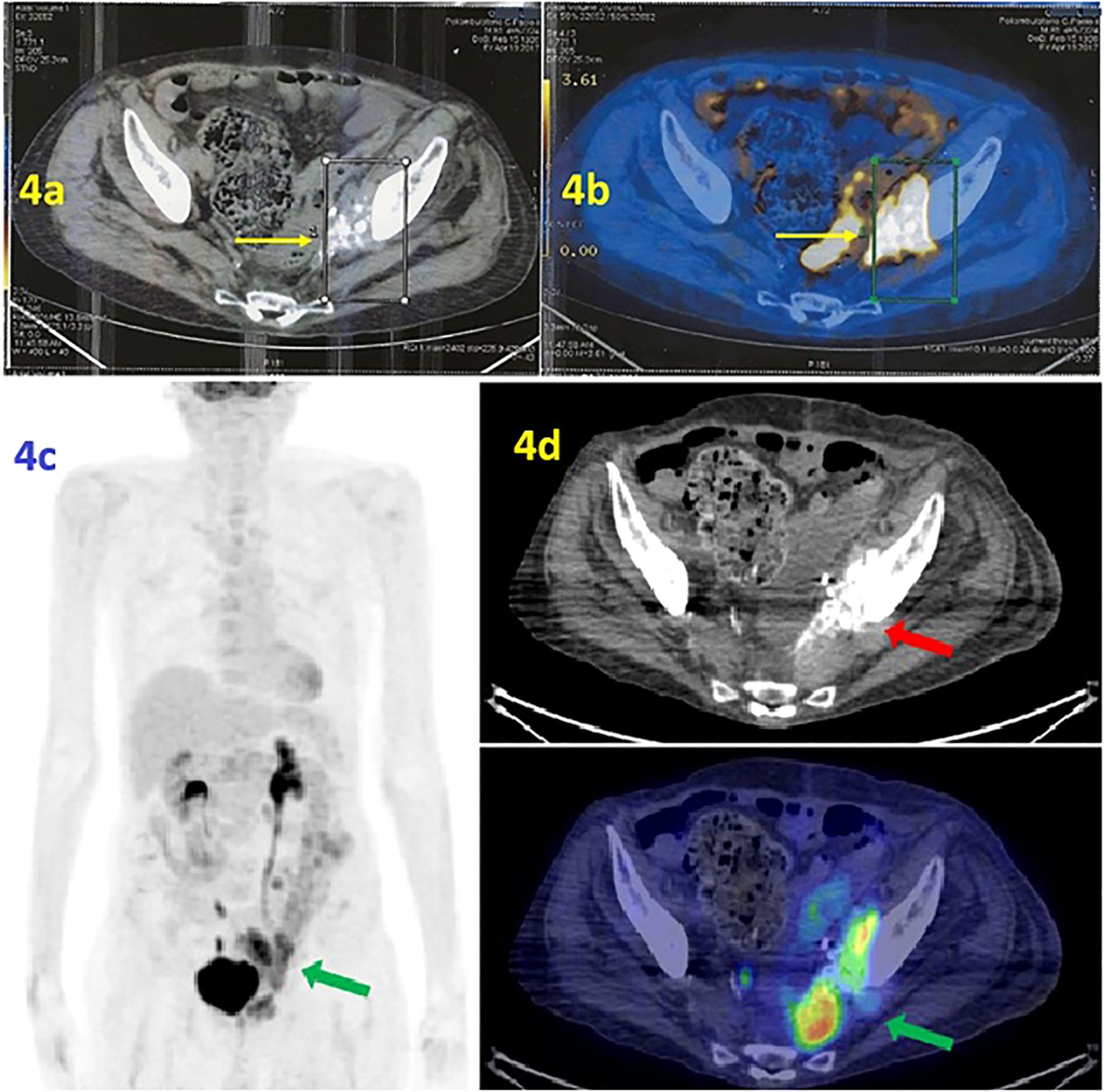 Medical imaging showing different scans of the pelvic area. Panel 4a is a grayscale scan with a yellow arrow. Panel 4b combines grayscale and color, highlighting an area with a yellow arrow. Panel 4c shows a full-body grayscale scan with a green arrow indicating a region in the pelvis. Panel 4d has two sub-images; the top is a grayscale scan with a red arrow, and the bottom is a color-coded scan with a green arrow highlighting activity.
