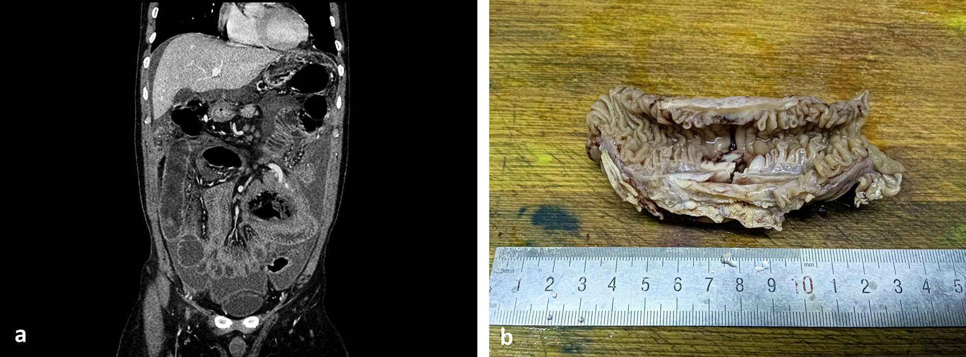 CT scan of the abdominal region showing internal organs with varying densities. Adjacent, a dissected specimen of intestinal tissue lies on a wooden surface next to a ruler, displaying its size and texture.