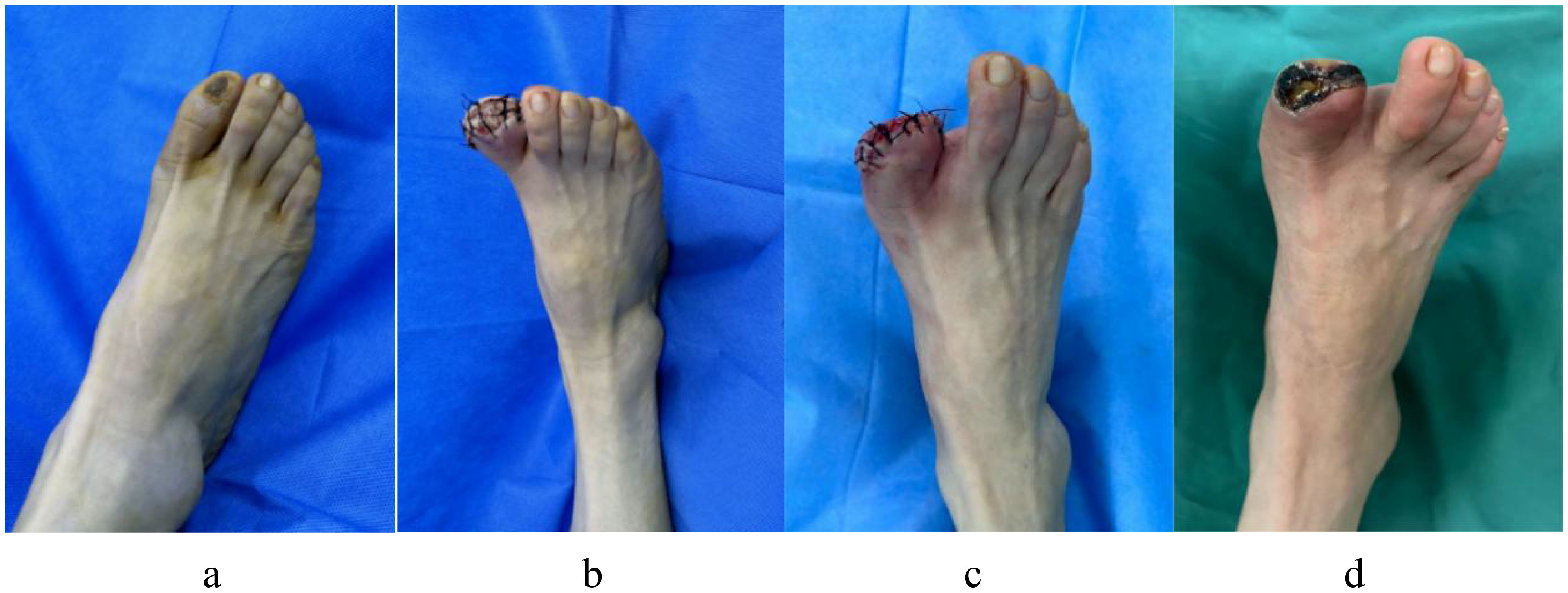 Four-panel image showing the progression of a medical condition on a foot: a) A discolored big toe, indicating early signs of a problem. b) Big toe after partial surgical removal with sutures visible. c) Another view of the toe post-surgery with stitches. d) Toe in advanced state with dark discoloration and visible necrosis.