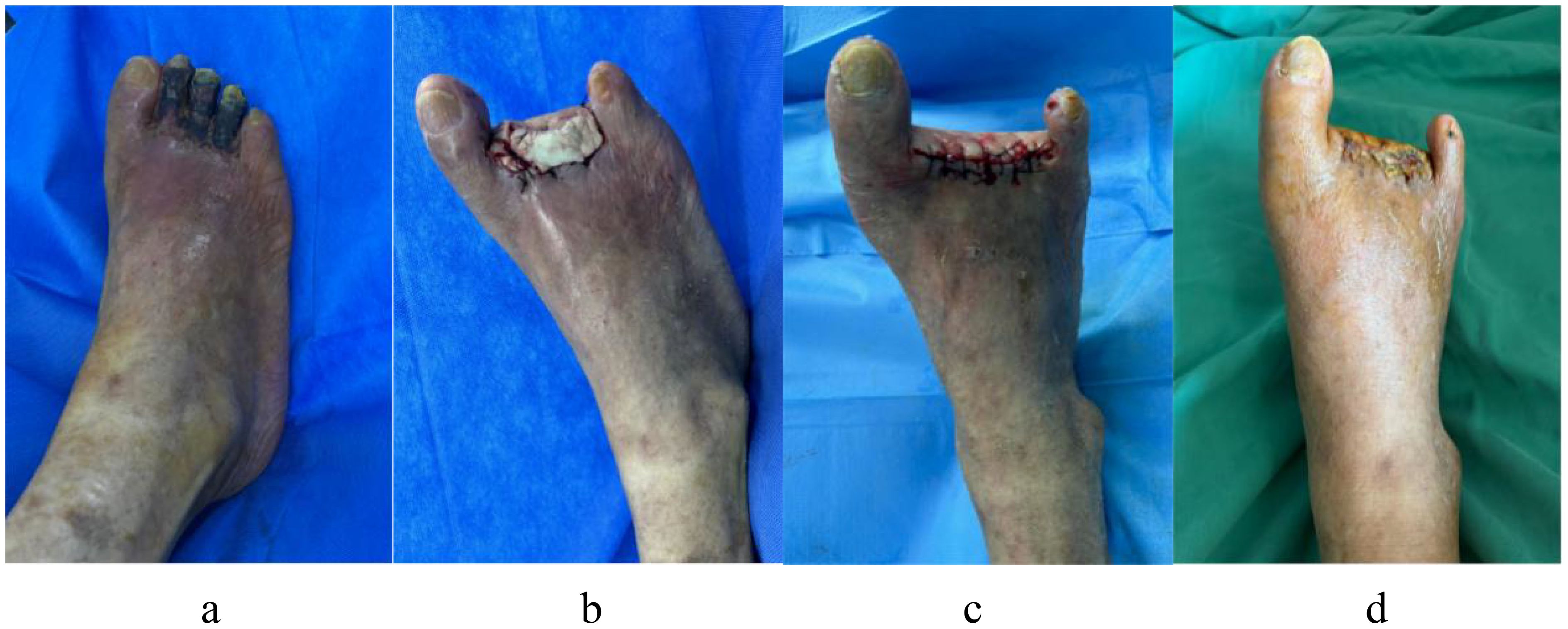 Four-panel image showing the stages of treatment for a foot condition. Panel a shows a foot with blackened toes. Panel b shows the foot post-amputation with partial closure. Panel c shows sutured closure after further healing. Panel d shows a healed foot with reduced scarring. All images are taken against a blue or green medical cloth background.