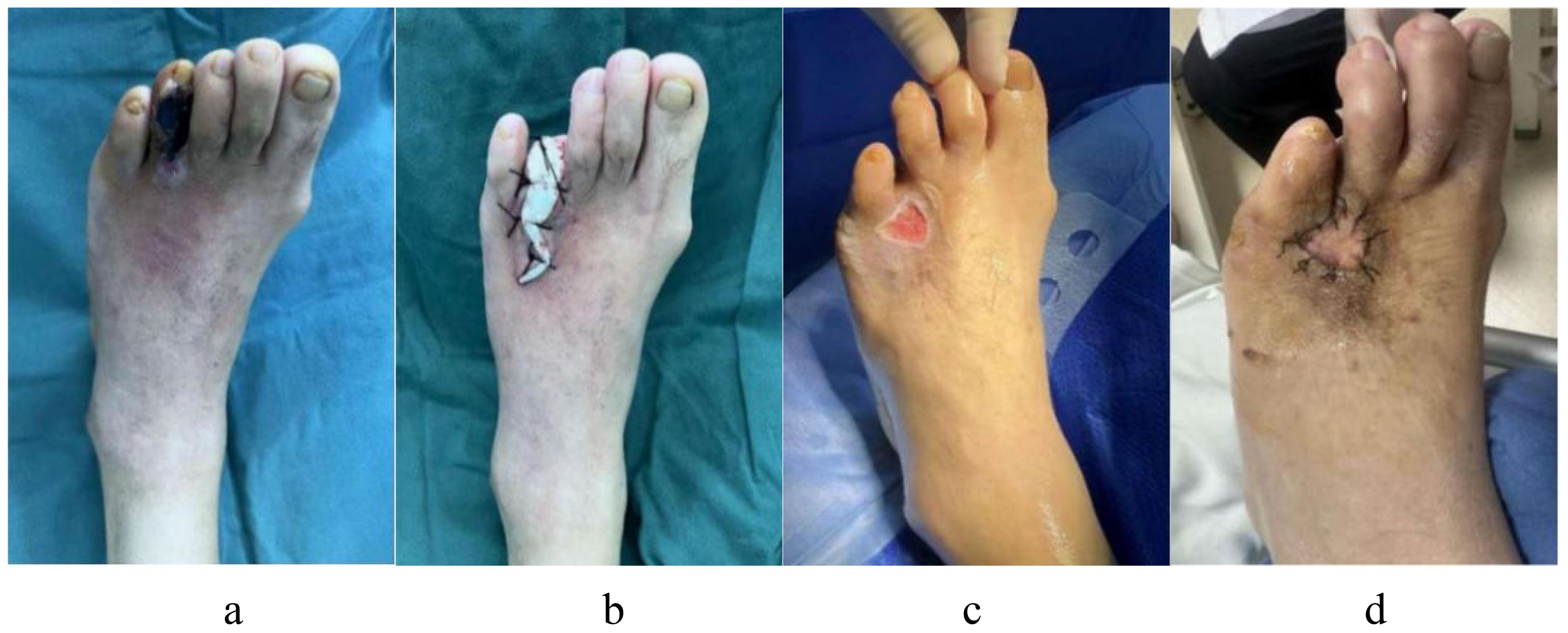 Four-panel image showing the stages of a toe surgical procedure. Panel (a) shows a foot with a blackened toe indicating necrosis. Panel (b) displays the foot post-surgery with sutures and bandages on the toe. Panel (c) shows the foot during recovery with a healing wound. Panel (d) depicts the foot with sutures removed, revealing progress in healing.
