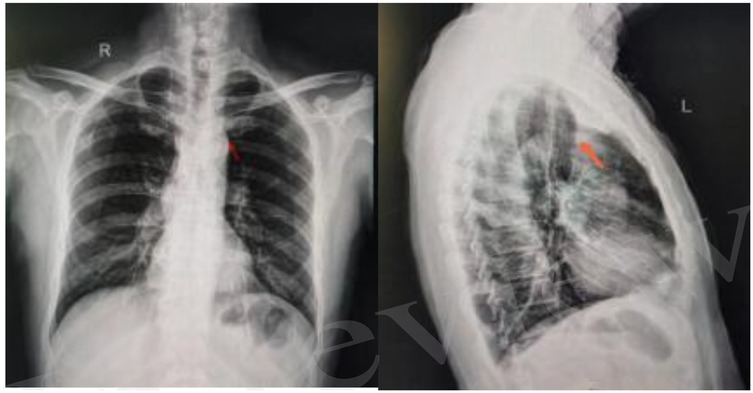 Two X-ray images of a human chest. The left image shows a frontal view, and the right shows a side view. Both images have a marked area in red near the center, possibly indicating a point of interest or abnormality.