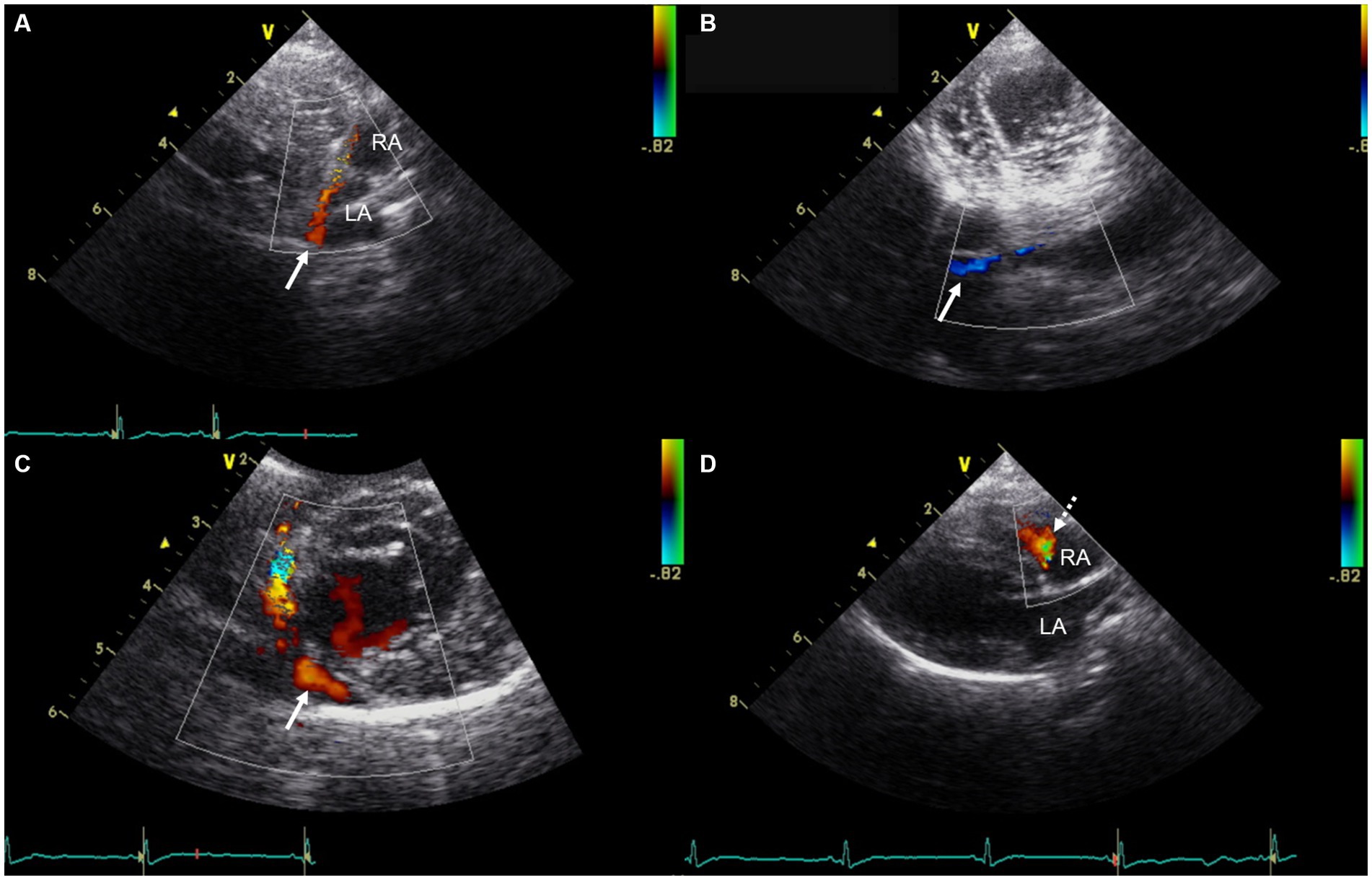 Color Doppler ultrasound images of the heart are displayed across four panels. Panels A to C show a markedly visualized tubular structure running along the posterior aspect of the left atrium and extending caudally to the right atrium, near the tricuspid valve annulus, which is presumed to represent the coronary sinus. Panel D reveals continuous blood flow entering the right atrium from an unidentified origin.