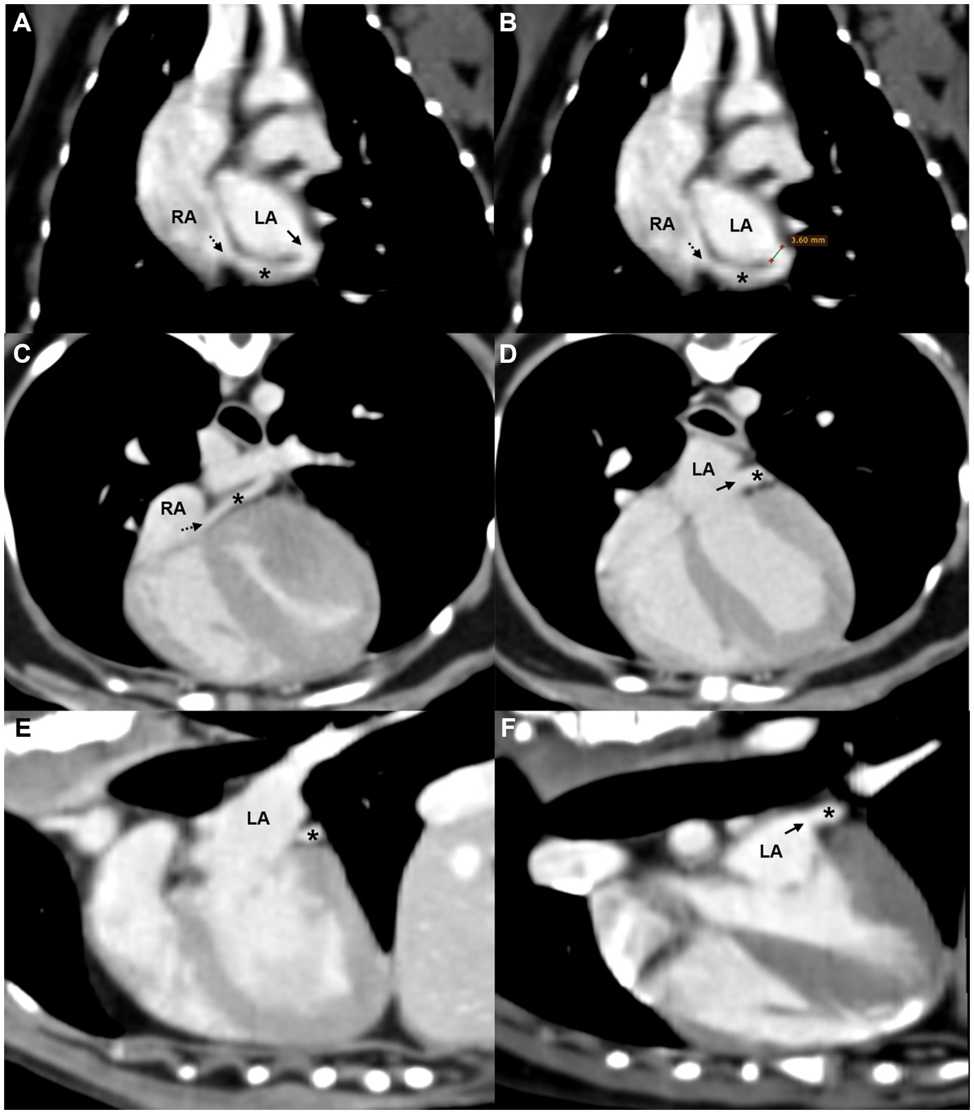 Oblique reformatted CT images in dorsal (A, B), axial (C, D), and sagittal (E, F) planes demonstrate a tubular structure consistent with the coronary sinus coursing behind the left atrium and draining into the right atrium. A partial defect is observed between the coronary sinus and left atrium, with similar contrast enhancement in both chambers. Panel B includes a measurement of the defect.