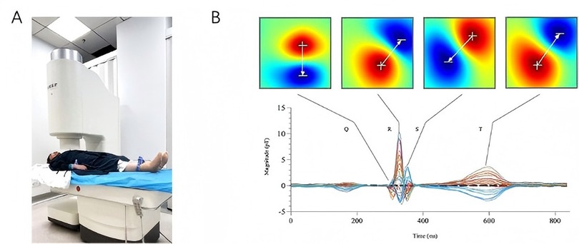 A person is lying on a scanner table in an open MRI machine. Above are four color-coded magnetic field maps, each showing different directions of vector arrows. Below these maps is a time-based graph with multiple overlapping lines, marked with Q, R, S, and T peaks, indicating magnetic signal changes over time.