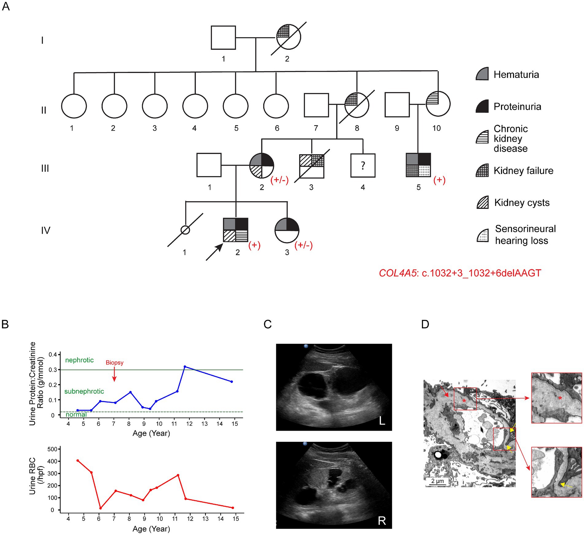 A four-panel image provides detailed information on a genetic and medical case study:A. A pedigree chart indicates a familial pattern of various conditions such as hematuria, proteinuria, chronic kidney disease, and sensorineural hearing loss. Specific individuals are marked with associated symbols.B. Two line graphs display data on urine protein-creatinine ratio and urine red blood cell count across ages 4 to 15, highlighting nephrotic and subnephrotic levels, with biopsy timing indicated.C. Ultrasound images of left and right kidneys show structural details.D. An electron micrograph with annotations highlights specific cellular features with close-up views.The genetic mutation COL4A5: c.1032+3_1032+6delAAGT is noted.