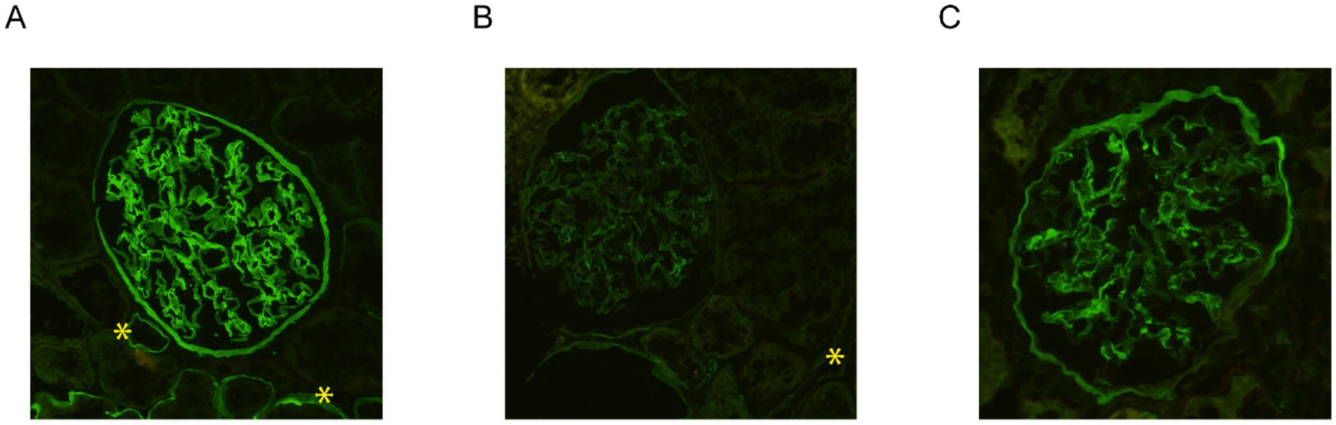 Fluorescent microscopy images of kidney glomeruli with green fluorescent staining, labeled A, B, and C. Each image shows varying intensities of green fluorescence against a dark background, indicating differences in cellular or structural composition. Yellow asterisks are visible in panels A and B.