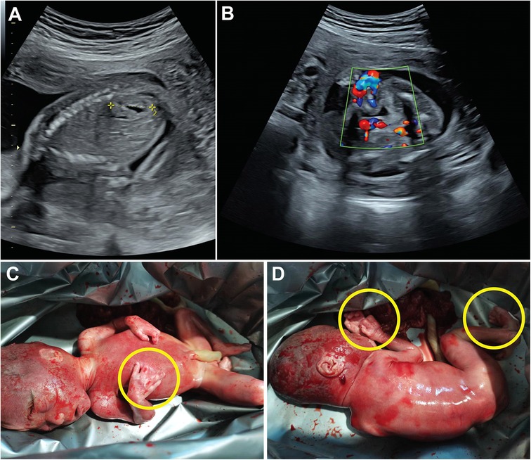 Ultrasound images labeled A and B show prenatal scans. Image A displays measurements, while image B includes color Doppler highlights. Images C and D depict a newborn with yellow circles marking limb abnormalities.