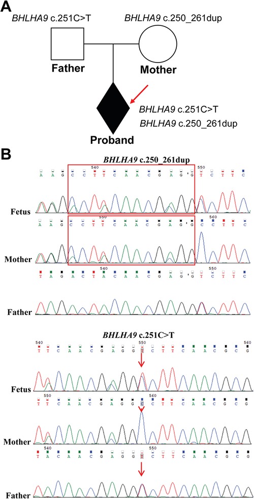 Panel A presents a pedigree chart showing genetic mutations in a family, with the proband indicated as having both BHLHA9 c.251C>T and c.250_261dup mutations. Panel B displays electropherograms for the fetus, mother, and father, highlighting the BHLHA9 c.250_261dup and c.251C>T mutations, with arrows pointing to specific genetic sequences.