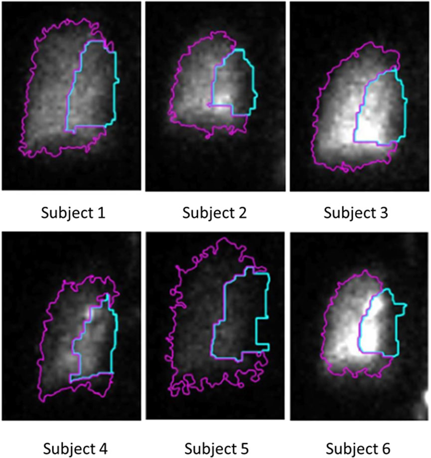 Six grayscale scintigraphic images labeled Subject 1 to Subject 6 display highlighted areas. Each image shows dense regions with overlaid purple and turquoise outlines, indicating specific areas of interest or analysis.