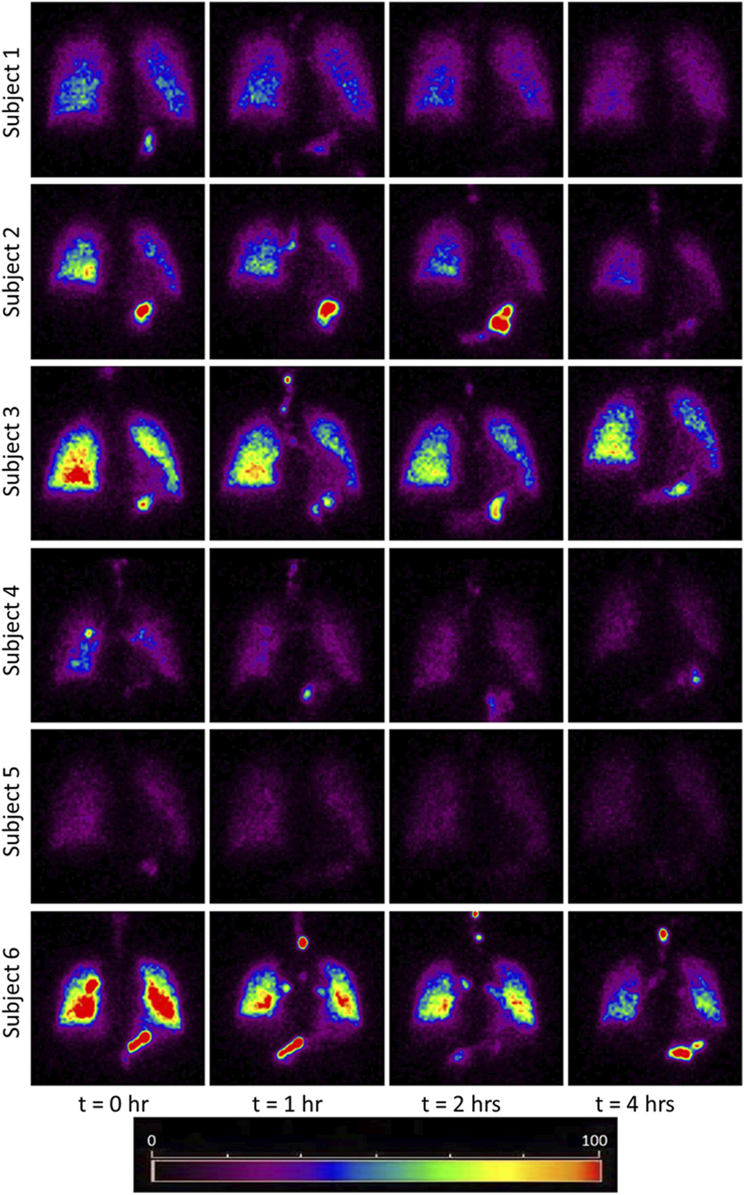 Six sets of heat map images show lung activity in subjects over time at intervals of zero, one, two, and four hours. Colors range from purple (low activity) to red (high activity). A color bar indicates intensity levels from zero to one hundred.