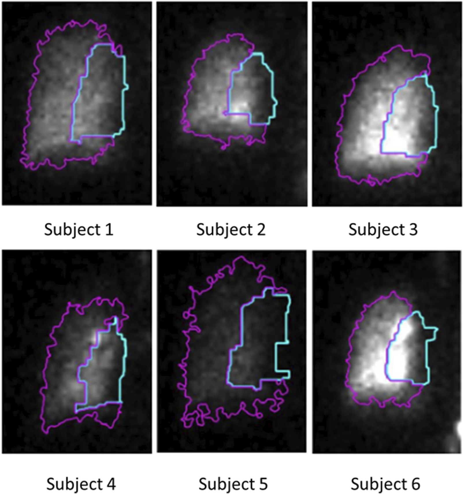 Six grayscale scintigraphic images labeled Subject 1 to Subject 6 display highlighted areas. Each image shows dense regions with overlaid purple and turquoise outlines, indicating specific areas of interest or analysis.