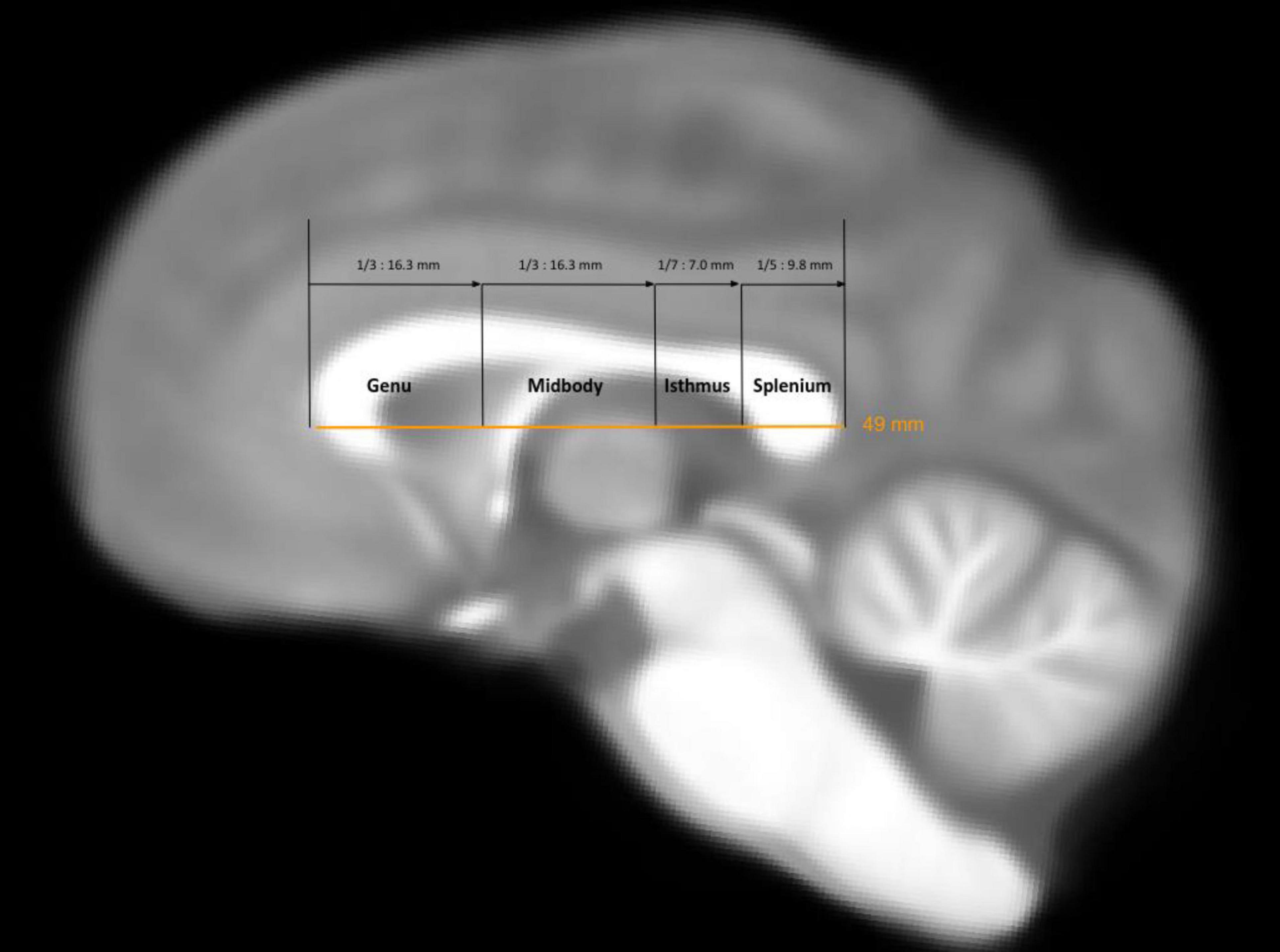 MRI scan showing the corpus callosum in the chimpanzee brain, divided into labeled sections: Genu, Midbody, Isthmus, and Splenium. Measurements display segment widths in millimeters, with a total length of 49 millimeters highlighted.