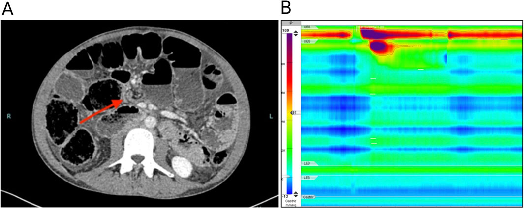 CT scan of an abdomen showing digestive tract structures, marked with a red arrow. Beside it, a colorful manometry graph depicts pressure variations.