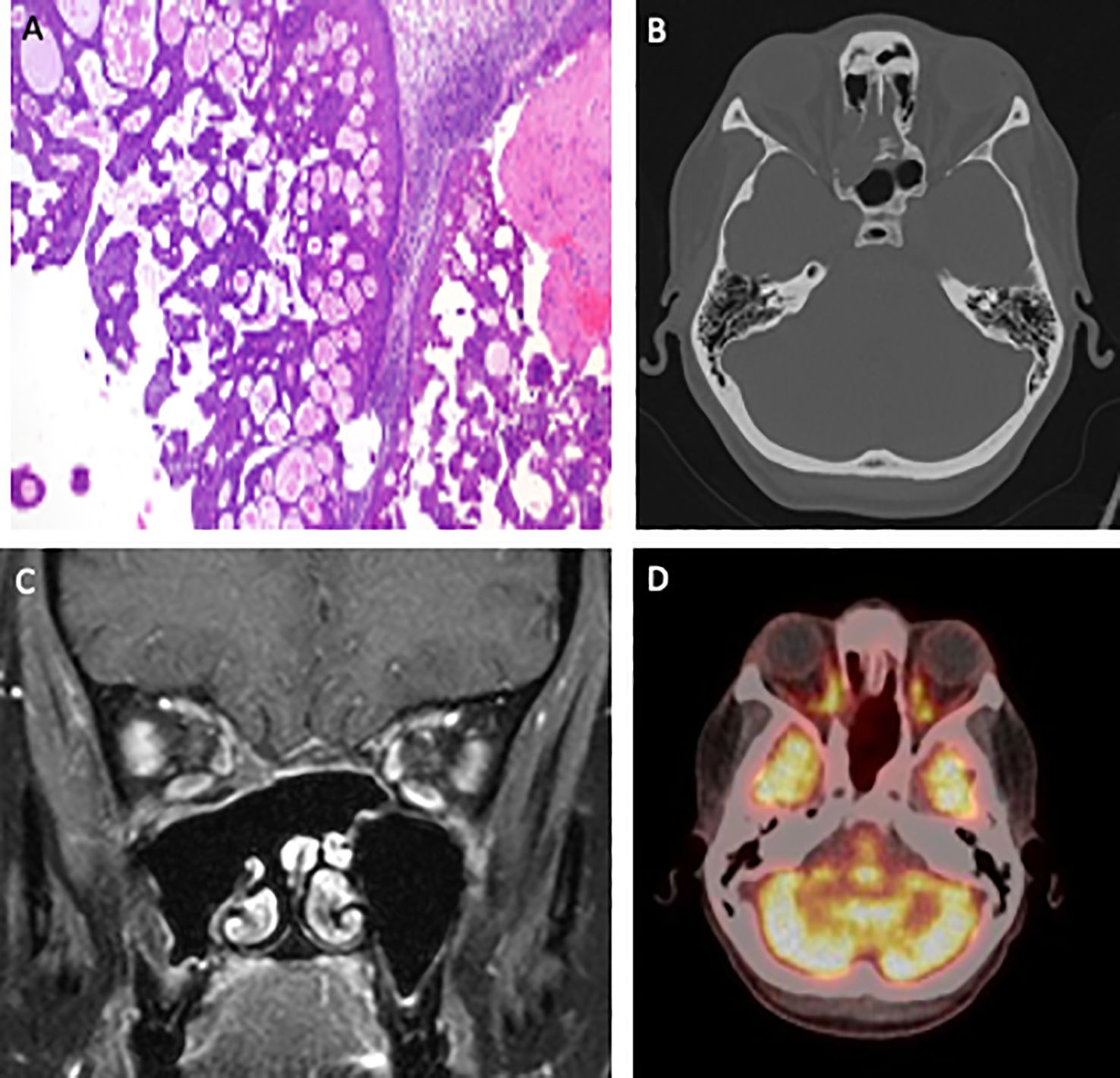 A composite image of four panels: A shows a CT scan of the skull, highlighting the bony structures and sinuses. B displays an MRI scan in a coronal view, focusing on sinus and nasal cavity details. C presents a PET scan illustrating metabolic activity, with highlighted areas in the brain and sinuses. D contains a histological tissue section stained in purple and pink, showing glandular structures and surrounding tissue.