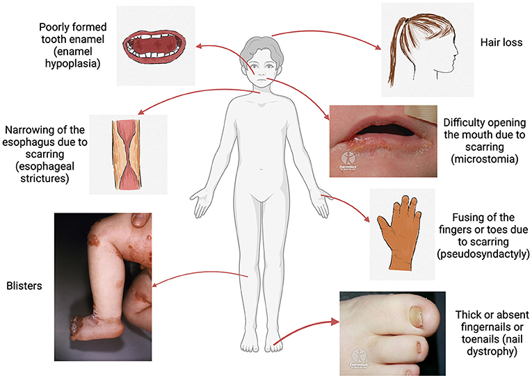 Illustration of common symptoms experienced by a person with epidermolysis bullosa. These symptoms include poorly formed tooth enamel, narrowing of the esophagus, blisters, hair loss, difficulty opening the mouth due to scarring, fusing of the fingers or toes, and thick or absent fingernails or toenails.
