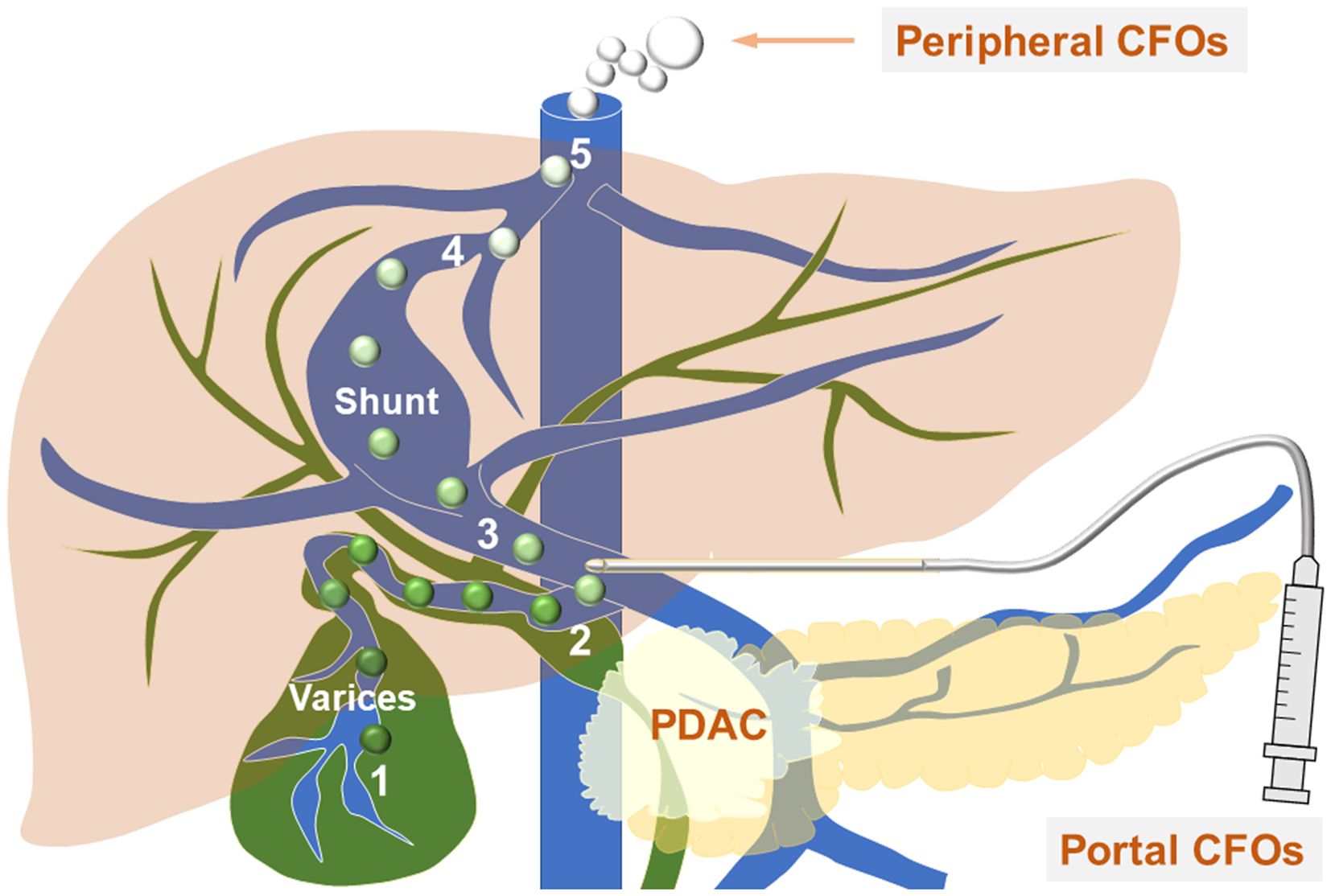 Diagram depicting the circulatory pathways related to varices and shunts in the liver area. It labels structures such as varices, a shunt, and PDAC. Arrows indicate the flow of circulation with labels for peripheral CFOs and portal CFOs. A syringe is shown at the portal CFOs, suggesting an interaction or treatment point.