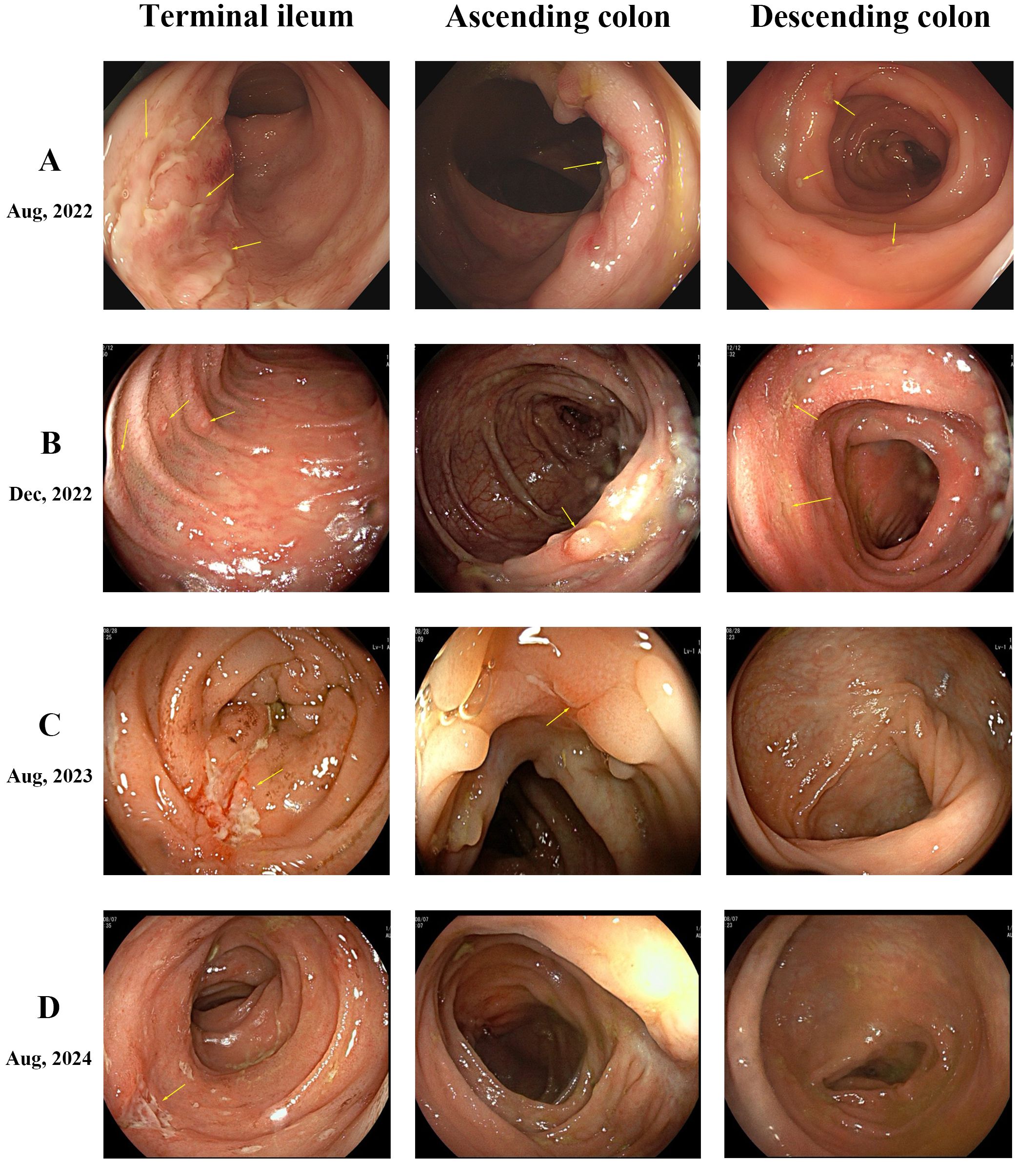 Sequential endoscopic images showing sections of the terminal ileum, ascending colon, and descending colon over four time periods: August 2022, December 2022, August 2023, and August 2024. Yellow arrows indicate areas of interest or abnormalities. The progression through time suggests changes in the intestinal mucosa. Each row represents a different time point corresponding to the labeled dates.