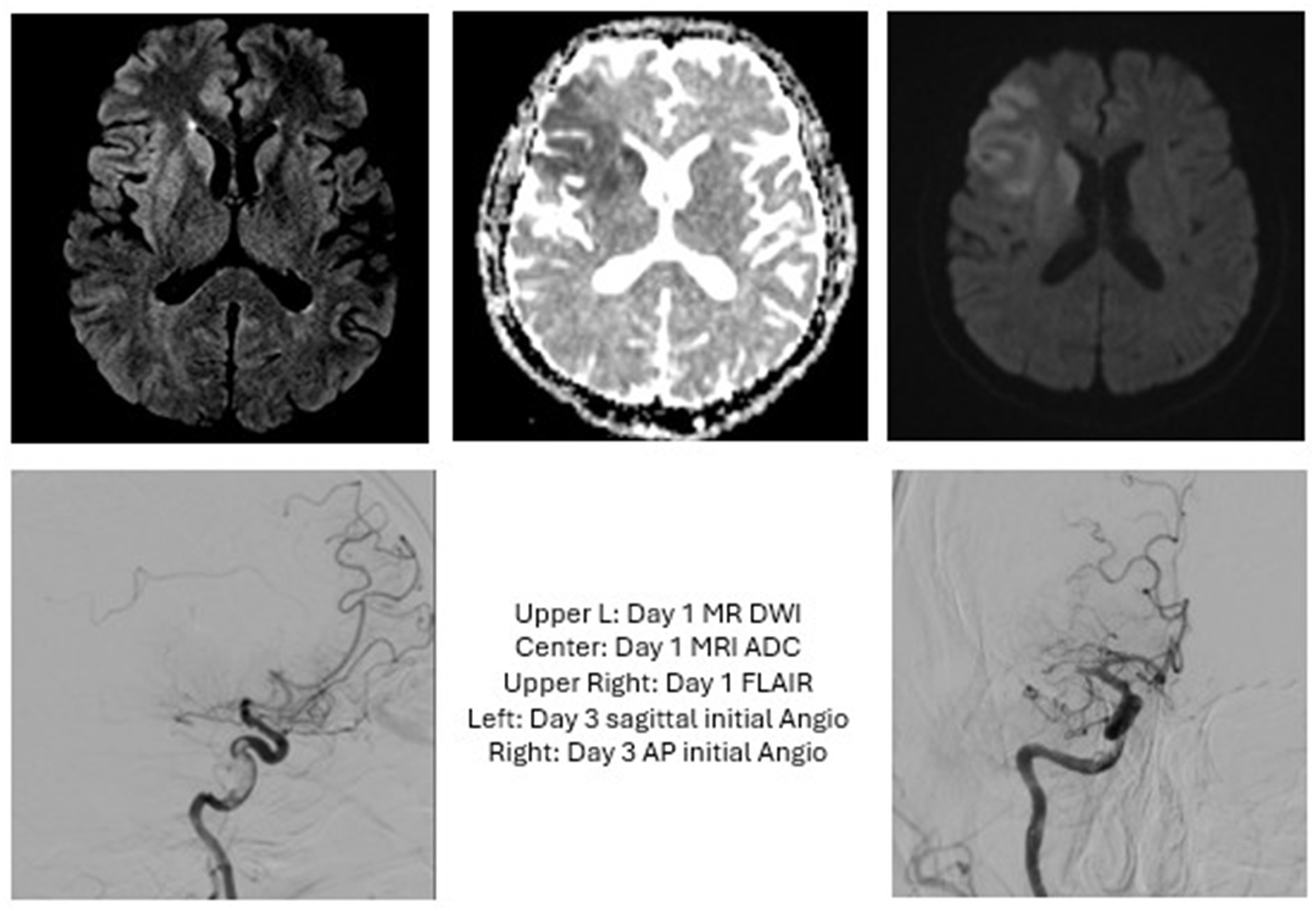 Three MRI images and two angiograms are displayed. The MRI images show brain scans in different modalities: diffusion-weighted imaging (DWI), apparent diffusion coefficient (ADC), and fluid-attenuated inversion recovery (FLAIR) from day one. The lower panel shows sagittal and anteroposterior (AP) views of brain angiograms from day three.