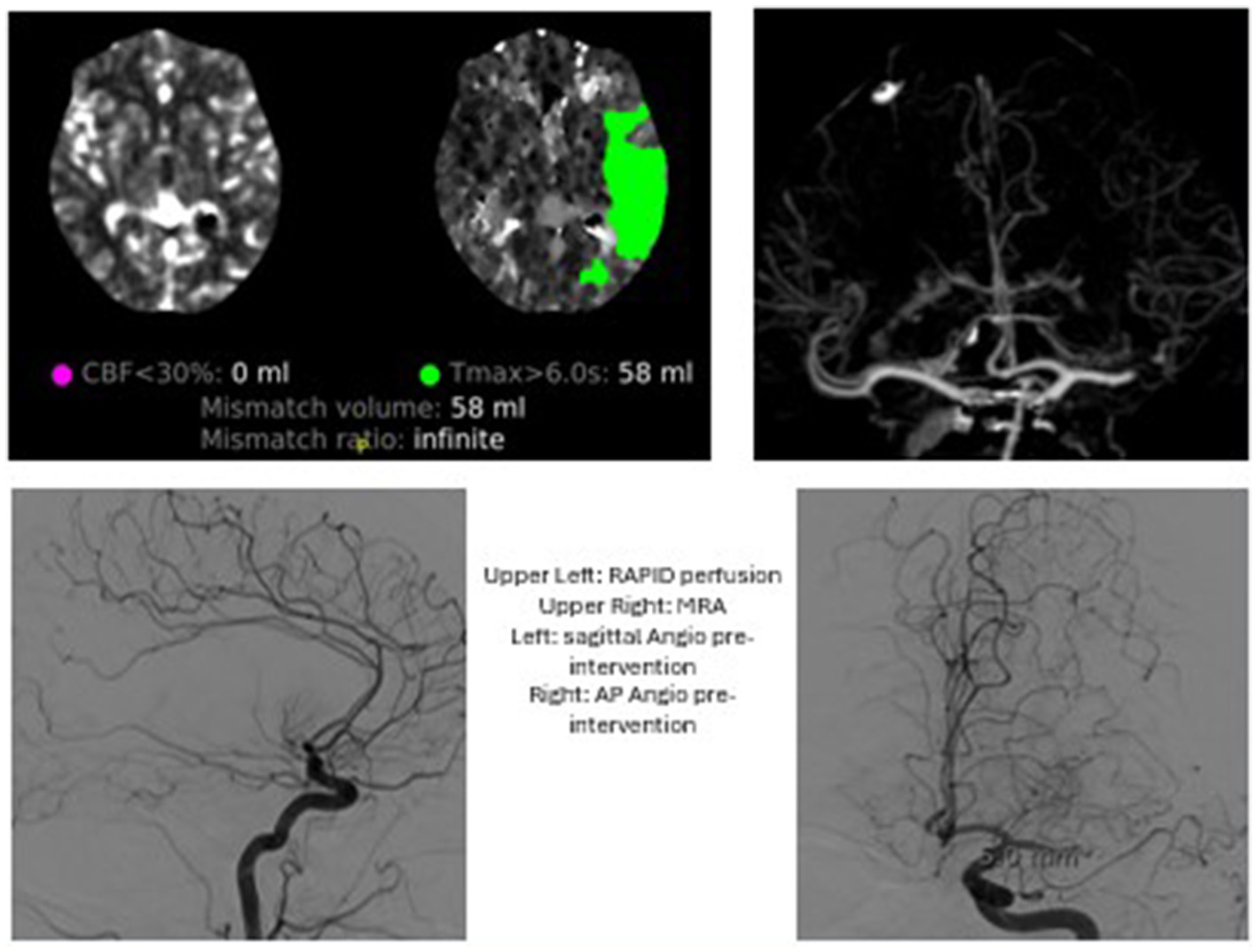 Medical imaging montage showing four images. Upper left: Brain perfusion scan indicating blood flow with color-coded regions; mismatch volume is 58 milliliters. Upper right: MRA displaying cerebral arteries. Lower left: Sagittal angiogram of brain vessels pre-intervention. Lower right: AP angiogram of brain vessels pre-intervention.