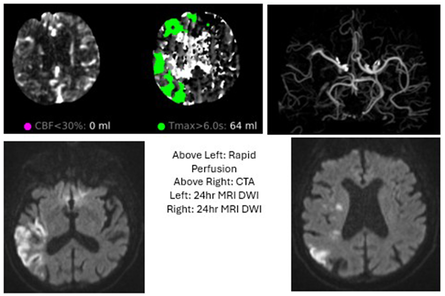 Brain imaging displays different scans. Top left: Rapid perfusion MRI with colored areas indicating blood flow. Top middle: Enhanced perfusion MRI showing areas of delayed blood flow. Top right: CTA illustrating cerebral arteries. Bottom images: Two 24-hour MRI DWI scans showing brain structure. Center text labels each image.
