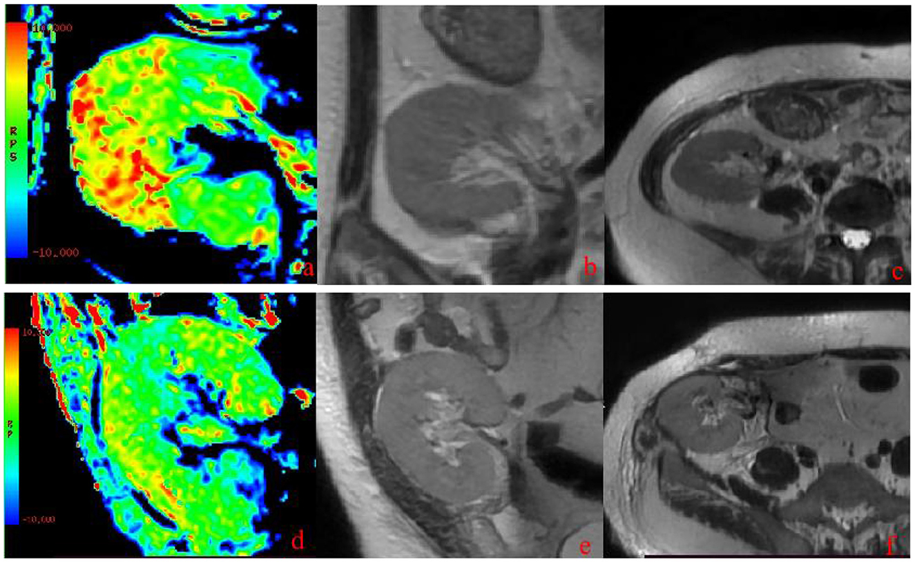 Six images arranged in two rows. The top row shows a color-coded imaging scan labeled “a,” alongside two grayscale MRI scans labeled “b” and “c.” The bottom row displays another color-coded scan labeled “d” and two grayscale MRI scans labeled “e” and “f.” The images appear to compare different imaging techniques, showing variations in anatomical structure visibility. Color scales are visible beside the color-coded images.