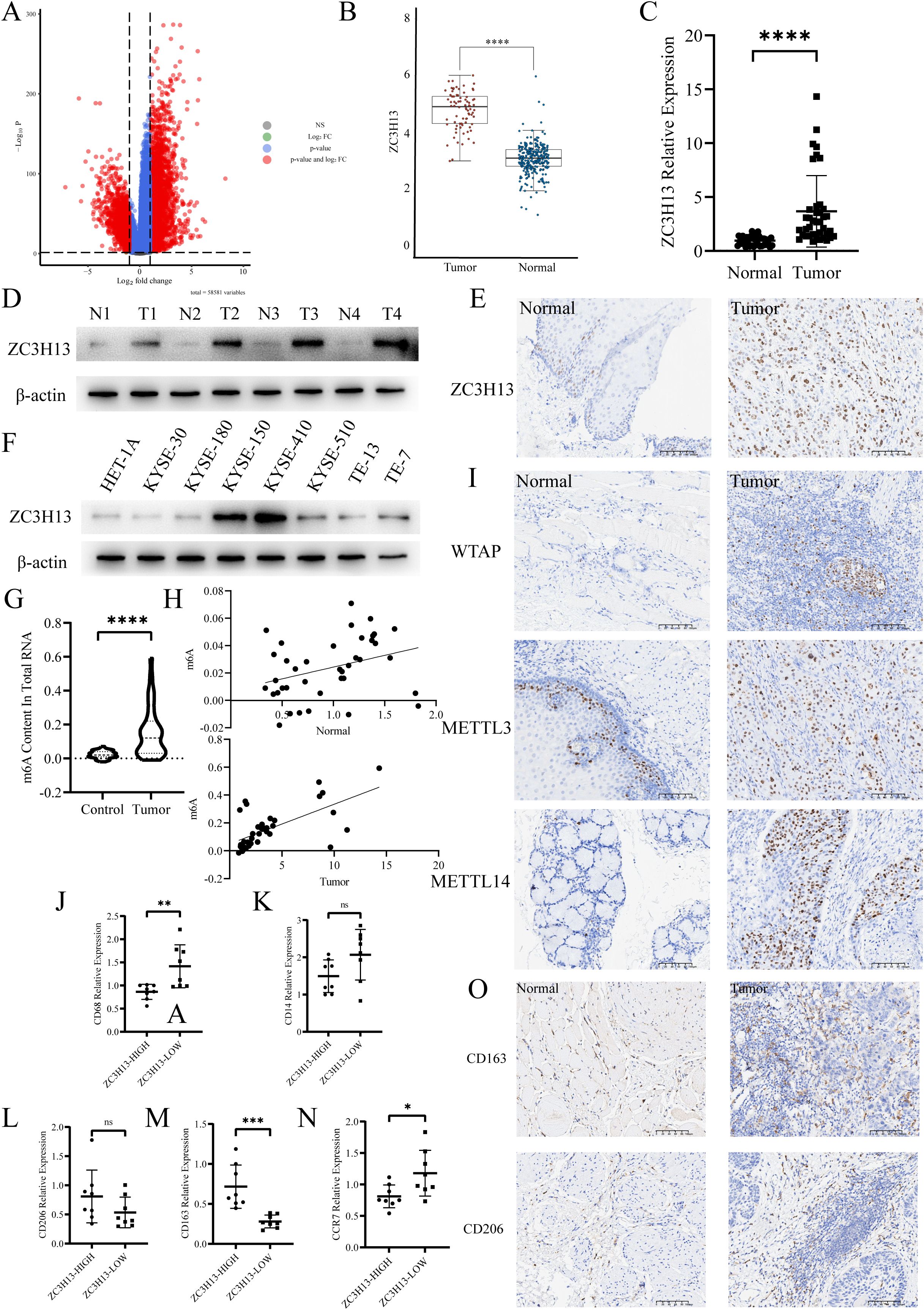 A composite image with multiple panels showing data related to ZC3H13 expression in tumor versus normal tissues. Panel A depicts a volcano plot. Panel B shows a box plot comparing ZC3H13 levels. Panel C is a scatter plot of relative expression levels. Panels D and F illustrate Western blot results for ZC3H13 and β-actin. Panel E and I feature immunohistochemistry images of tissues stained for ZC3H13 and WTAP. Panel G includes a violin plot for m6A content in RNA. Panel H shows scatter plots for METTL3 and METTL14. Panels J, K, L, M, and N present various gene expressions. Panel O includes additional tissue images stained for CD163 and CD206.