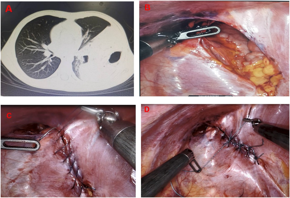 Panel A shows a CT scan of the chest revealing a nodule in the lung. Panel B illustrates surgical instruments working on tissue inside the chest cavity. Panel C displays sutures being placed during the procedure. Panel D shows the completed sutures securing the tissue.
