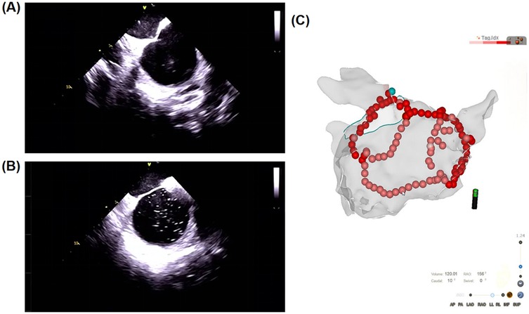 Ultrasound images and a 3D anatomical model are presented. Panel (A) displays an ultrasound cross-section, and panel (B) shows another cross-section with clearer cavity details. Panel (C) features a 3D visualization with red spheres outlining a structure, accompanied by measurement data in the lower right corner.