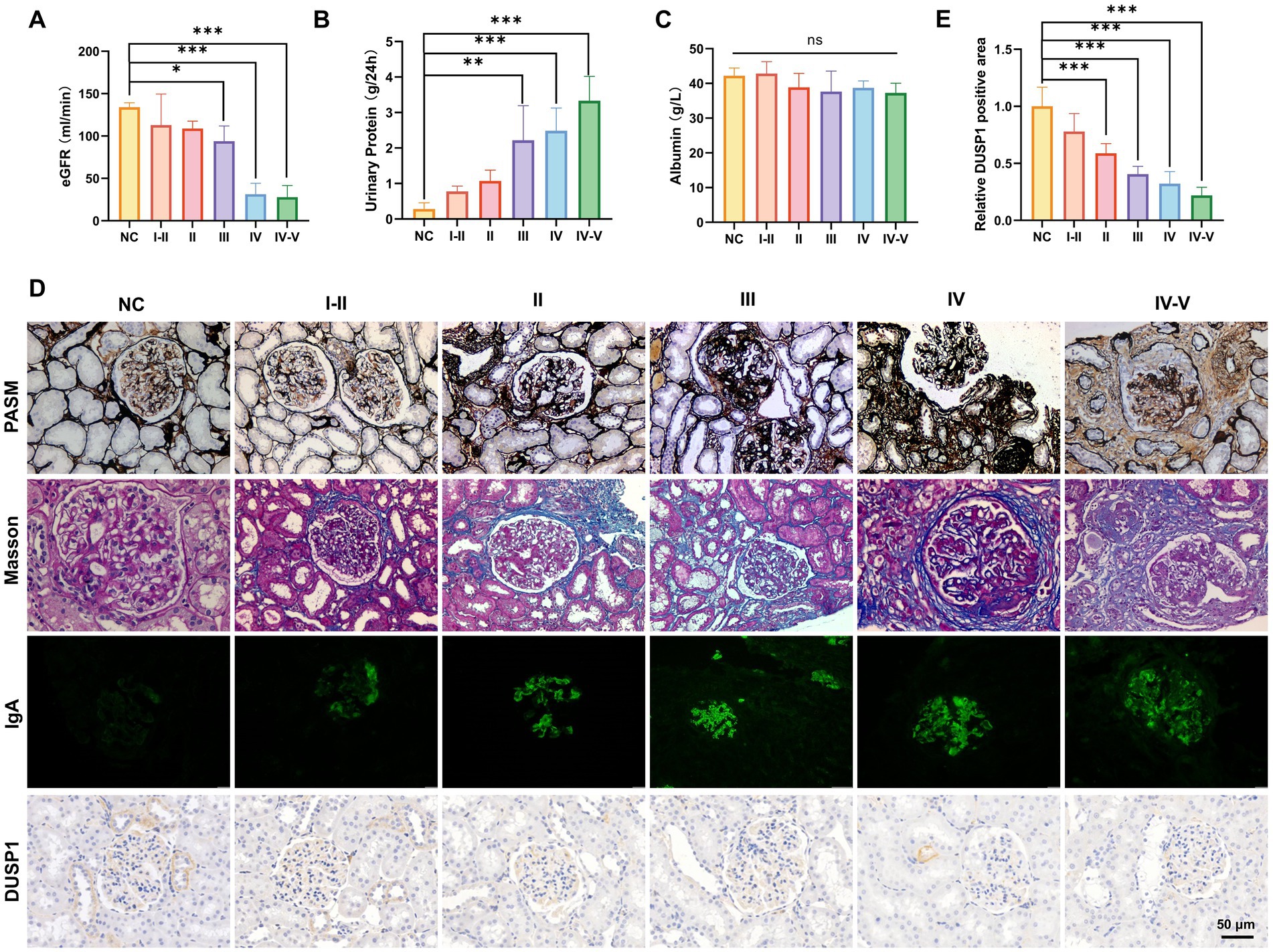 Charts and images depict various stages of kidney analysis. Charts A to C show changes in eGFR, urinary protein, and albumin levels across different clinical stages, with statistical significance indicated. Chart E illustrates DUSP1 positive area variations. Panel D presents microscopic images using PASM, Masson, IgA, and DUSP1 staining techniques, highlighting glomerular changes in different patient groups, labeled NC, I-II, II, III, IV, and IV-V. Each row displays distinct staining outcomes, revealing morphological differences, with scale indicated as 50 micrometers.