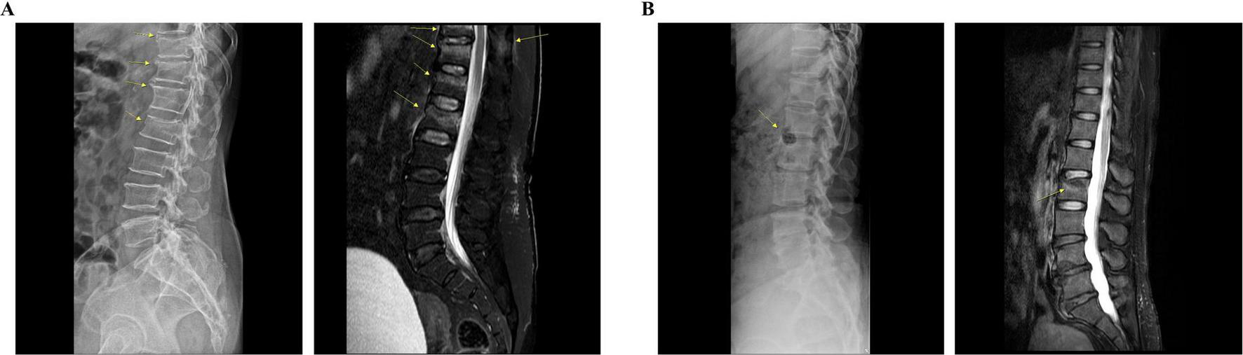 Panel A shows two spinal images, one X-ray on the left and one MRI on the right, highlighting vertebrae. Panel B also displays an X-ray and MRI of the spine, with similar annotations marking specific vertebrae.