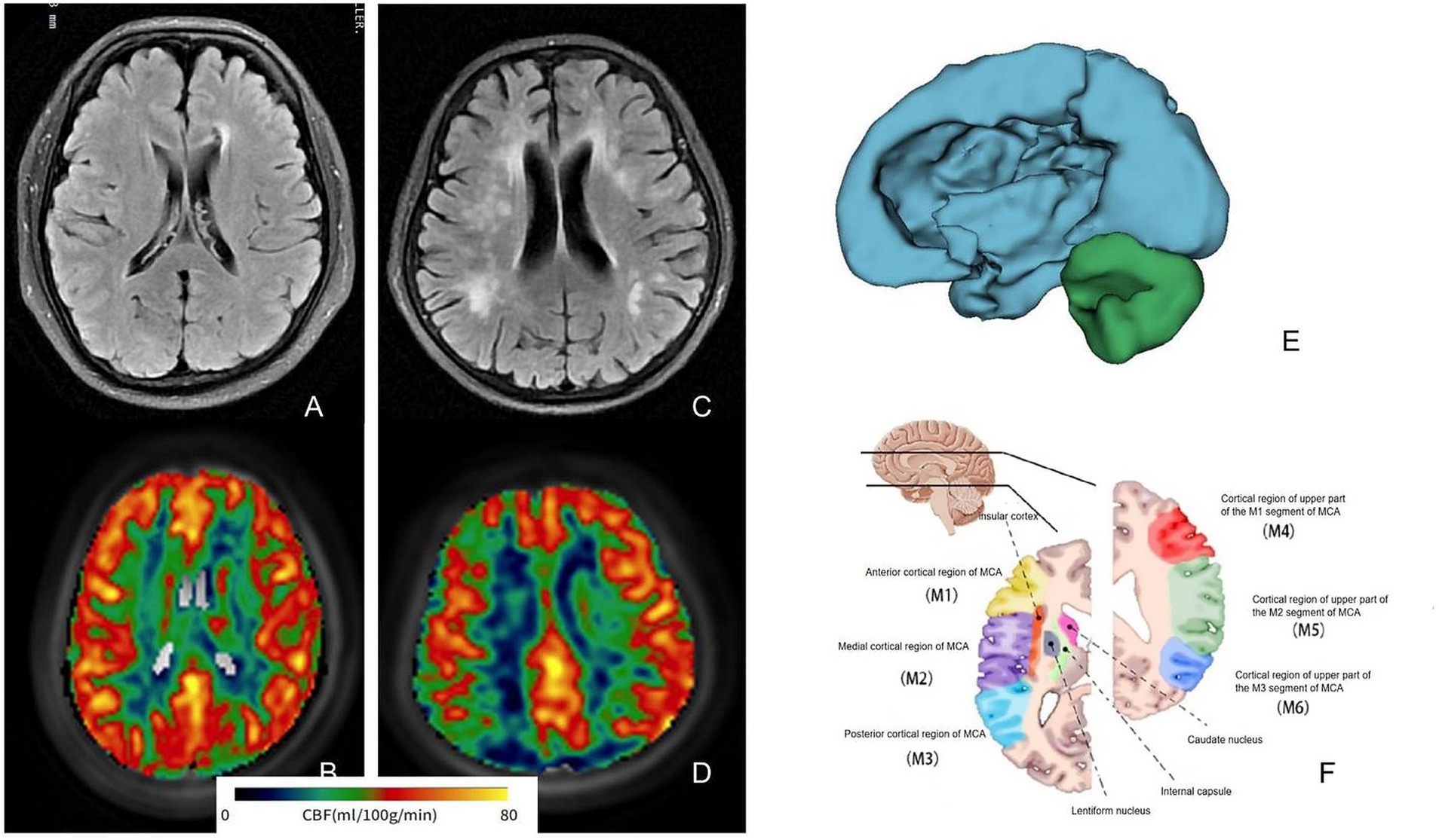 Medical imaging includes two brain scans showing MRI and CBF; labeled A, B, C, D. One MRI shows brain structures, while CBF displays color-coded blood flow, with a scale from 0 to 80. A diagram illustrates brain regions and blood supply, labeled E and F, highlighting cortical areas and segments of the middle cerebral artery.