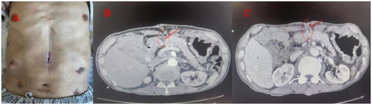 Image panel showing three parts: (A) an abdomen with multiple surgical scars; (B) a CT scan of the abdomen with an arrow pointing to a specific area; (C) another CT scan with an arrow highlighting a different section.