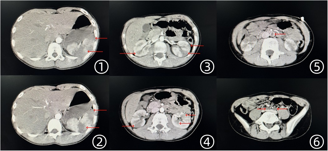 Six CT scan images labeled with numbers. Each scan shows cross-sectional views of the abdomen with red arrows indicating specific areas: Image 1 and 2 show two arrows pointing to the liver. Image 3 shows arrows pointing to the kidneys. Image 4 highlights areas near the spine. Image 5 points to structures near the stomach. Image 6 focuses on the pelvic region.