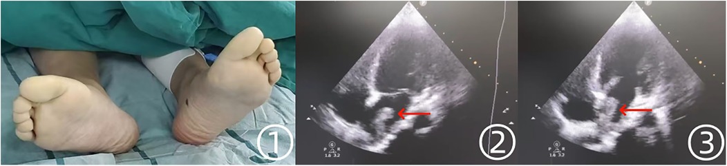 1. Two feet are positioned soiled up on a hospital bed, with medical drapes partially visible. \n2. An ultrasound image shows a scan with a red arrow pointing to a specific area. \n3. Another ultrasound image features a red arrow highlighting a different focused area.