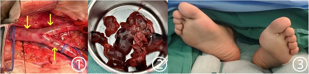 Panel 1 shows an exposed artery during surgery with yellow arrows highlighting certain areas. Panel 2 displays a metal container holding several blood clots. Panel 3 depicts the soles of feet, viewed from underneath a surgical drape.