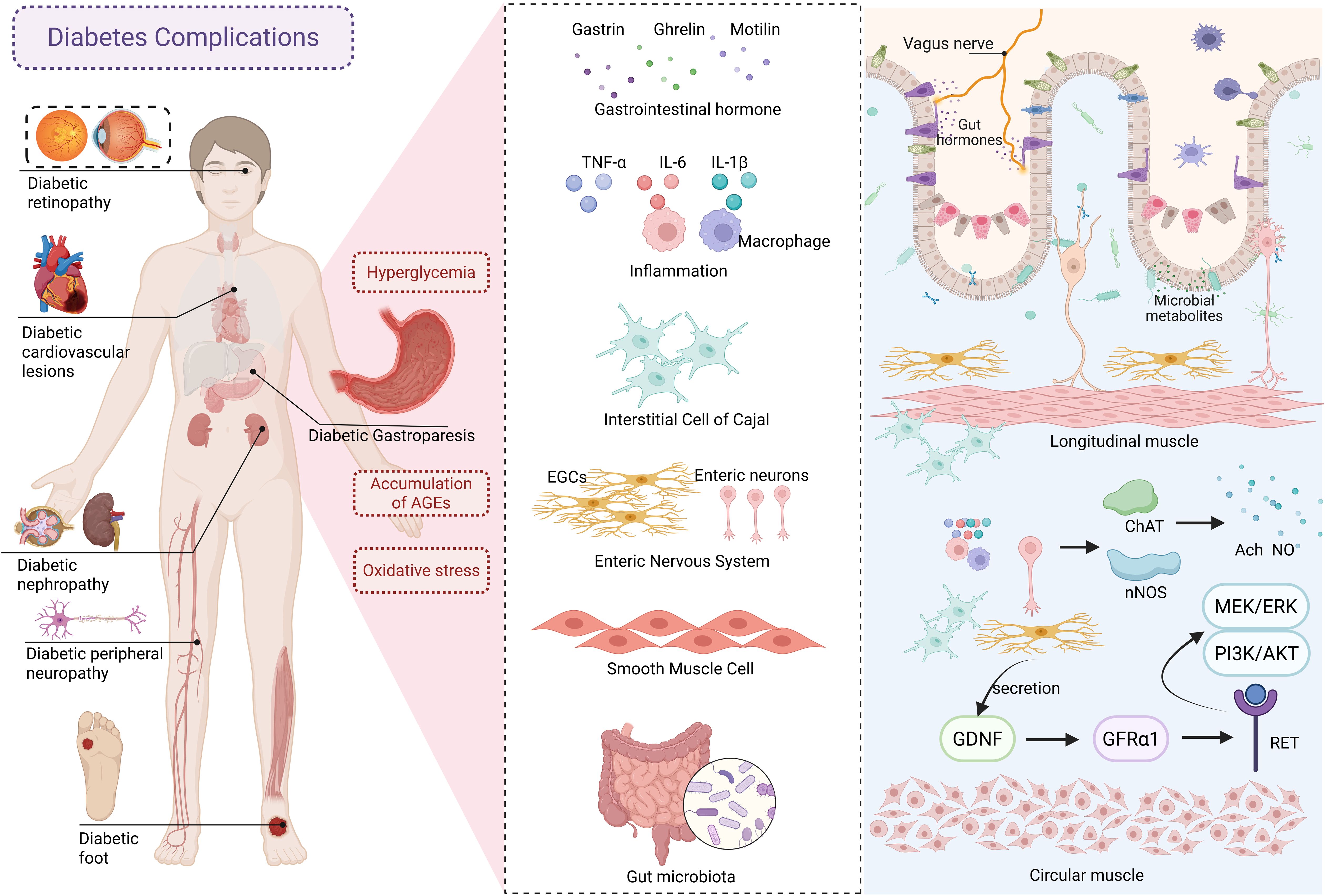 The illustration shows the pathological mechanisms of diabetic gastroparesis. The left panel shows an image of the human body, highlighting diabetic retinopathy, cardiovascular disease, kidney disease, gastroparesis, peripheral neuropathy, and diabetic foot. The middle panel illustrates the pathological mechanisms associated with diabetic gastroparesis, listing factors such as gastrointestinal hormones, inflammation, interstitial cells, the enteric nervous system, smooth muscle cells, and the gut microbiota. The right panel provides a detailed explanation of the interactions involved in the pathological mechanisms of diabetic gastroparesis, including the vagus nerve, microbial metabolites, and pathways involving ChAT, nNOS, GDNF, GFRa1, and RET.