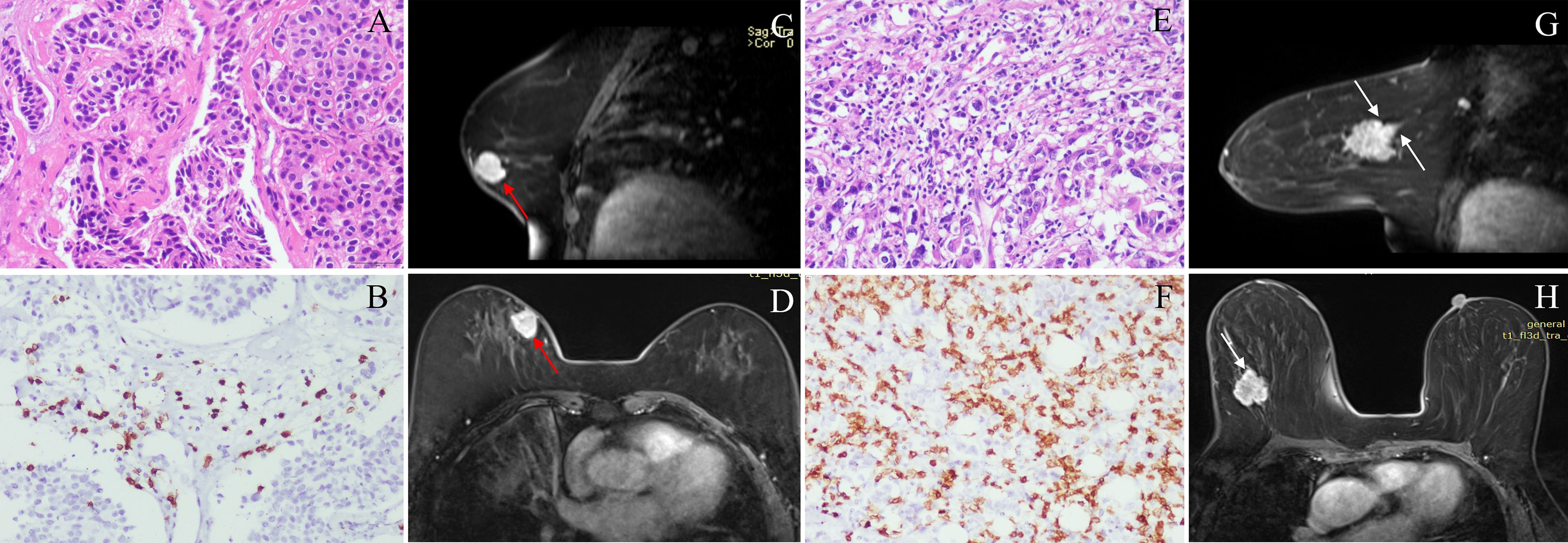 Panel of images includes both histopathological and MRI scans. A and E show different tissue samples under the microscope with dense cellular structures. B and F show stained slides with specific markers highlighted. C and D display sagittal and axial MRI scans with arrows pointing to bright spots indicating regions of interest. G and H are MRI images with arrows highlighting mass formations in breast tissue.