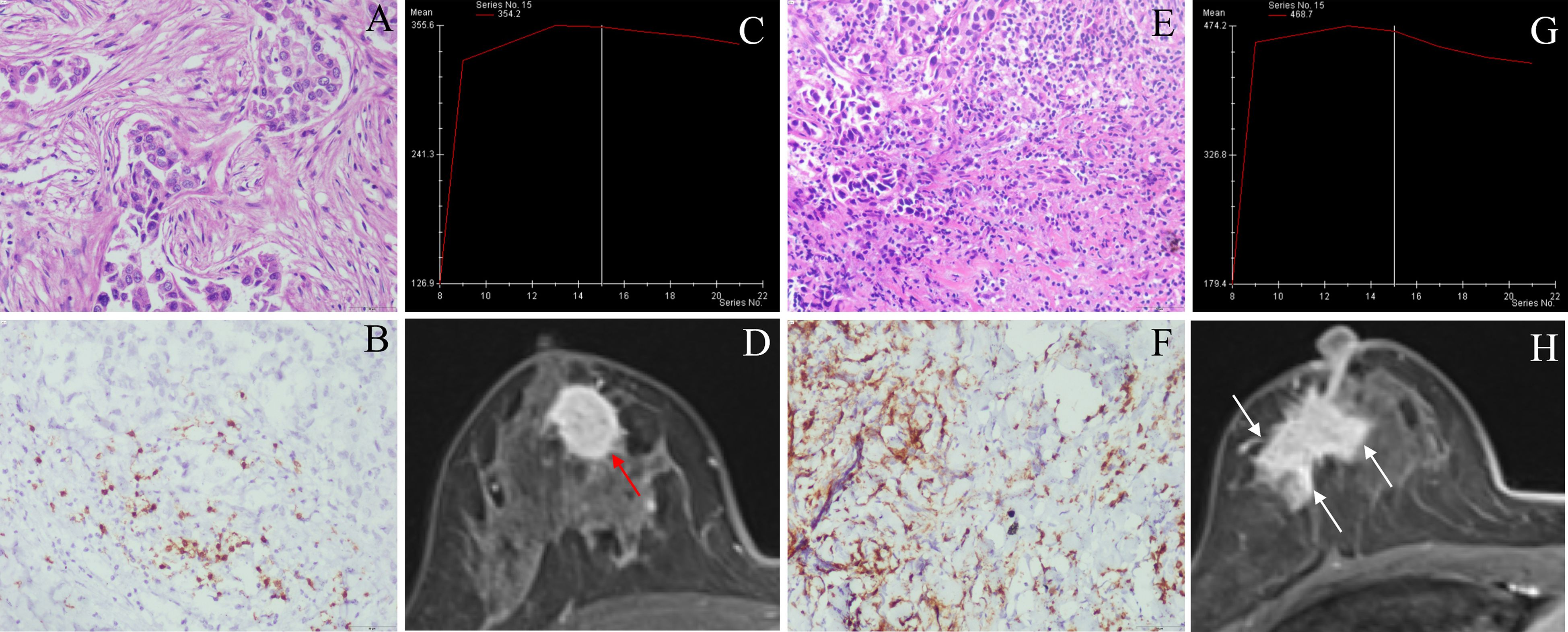 Panel of eight images showing breast tissue samples and MRI scans. A and E show histopathological sections with densely packed cells stained in purple. B and F depict immunohistochemical staining with light coloration and scattered dark spots. C and G are graphs indicating series data with lines peaking around series number 15. D is an MRI with a red arrow pointing to a circular mass. H is an MRI showing a larger mass with white arrows.