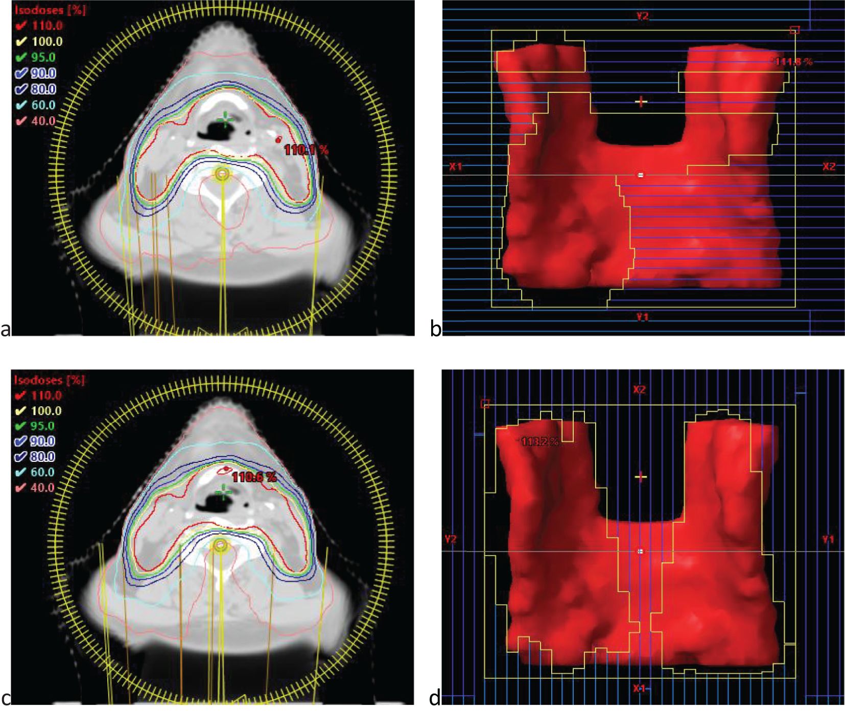 Medical imaging comparison featuring two pairs of images labeled a-b and c-d. Images a and c display isodose curves on a cross-sectional view of a body, showing varying dose distributions with different color-coded lines. Images b and d show red, grid-like visualizations with markings indicating measurements or divisions. Both pairs likely represent different stages or settings of a radiation treatment plan.