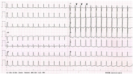 Electrocardiogram (ECG) showing multiple leads with a regular, rapid rhythm. All leads display similar wave patterns, and specific leads (like V1) are marked with arrows. The ECG is dated October 18, 2023, at 14:00:26.
